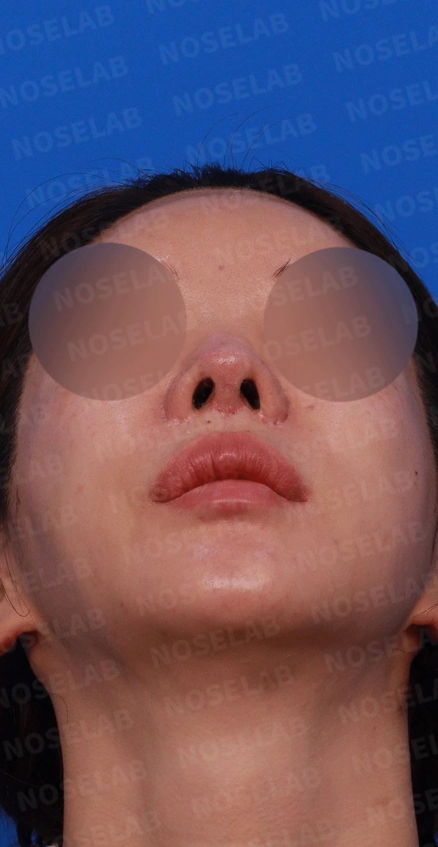 코 수술 뒤 콧등 피부가 괴사하면 어떤 변화가 남고, 재건은 어떻게 하나 — 디자인 상담 비스듬한 측면 , 좌측 측면, 비공 사진