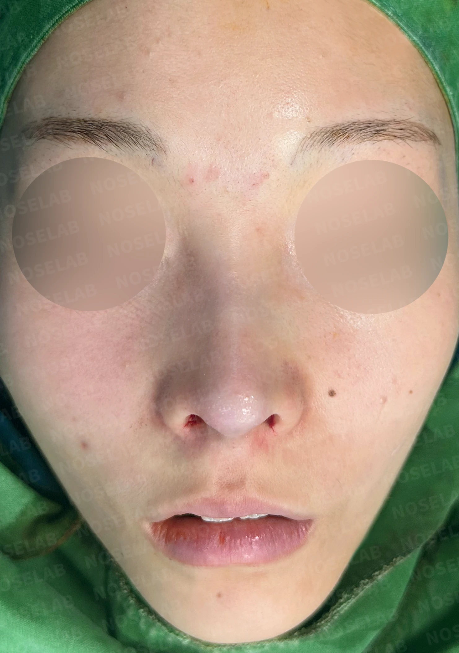 낮고 퍼진 코, 기증늑연골과 실리콘 보형물로 자연스러운 코 라인 완성 — 수술직후 정면, 비스듬한 측면, 측면 사진입니다.