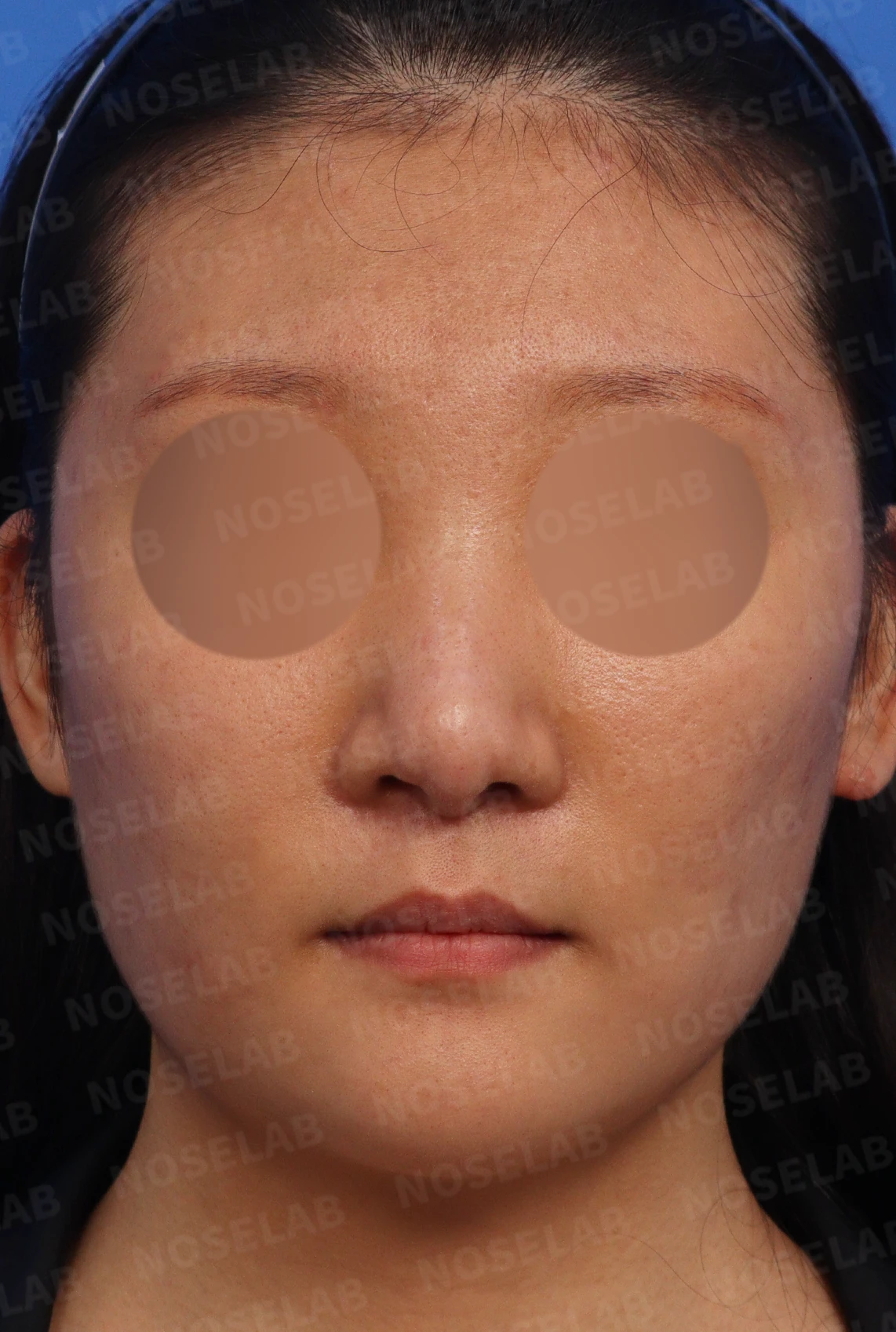 주입된 이물질을 제거하고 코를 재건하는 방법 — 수술전 디자인 정면, 측면, 비스듬한 측면