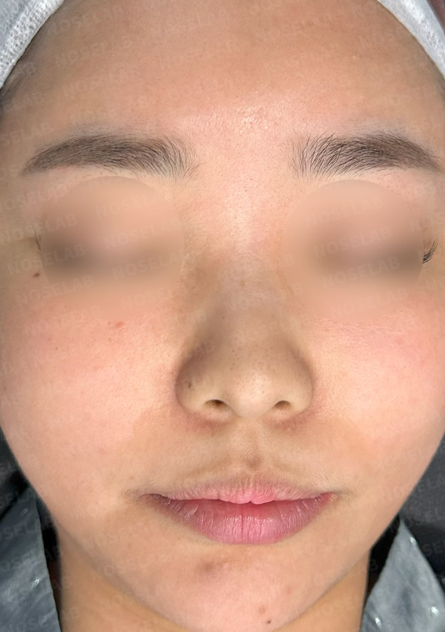 비염 수술을 받았는데도 코막힘이 돌아오는 이유, 구조 교정은 어떻게 하나 — 수술 전 / 수술 직후 0일 직후 사진은 부기가 있는 상태로 최종 결과와 다를 수 있습니다.