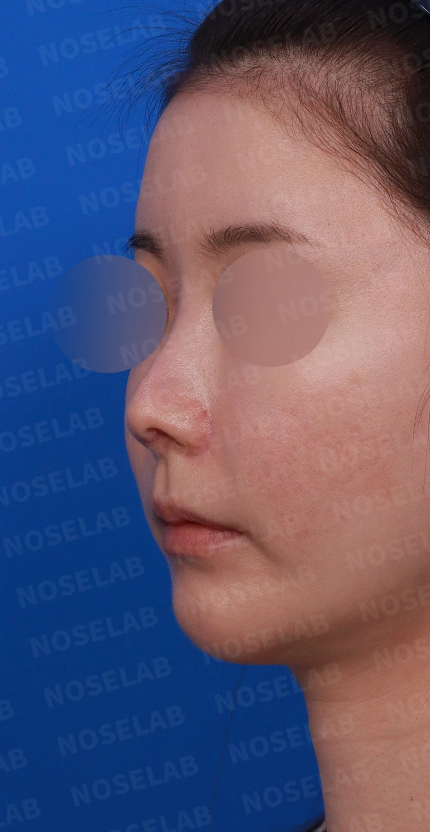 코성형 후 남는 미세한 높이 부족과 좌우 비대칭, 왜 생기고 어떻게 보강하나 — 디자인 상담 정면 , 좌측 측면 , 비스듬한 측면 사진입니다.
