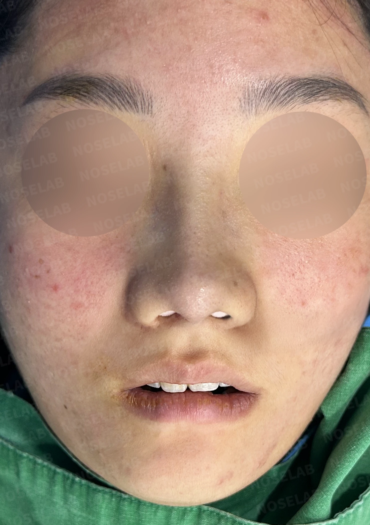 콧대가 낮고 코끝이 뭉툭해 보이는 이유, 함몰된 비주와 함께 교정하는 방법 — 수술 직후 0일 정면, 비스듬한 측면, 측면 사진입니다. 직후 사진은 부기가 있는 상태로 최종 결과와 다를 수 있습니다.