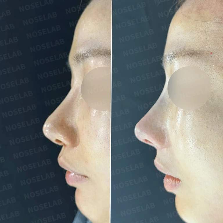 휘어진 코와 돌출입 개선 - 자가늑연골 재건 실제 후기 — 전후 비교