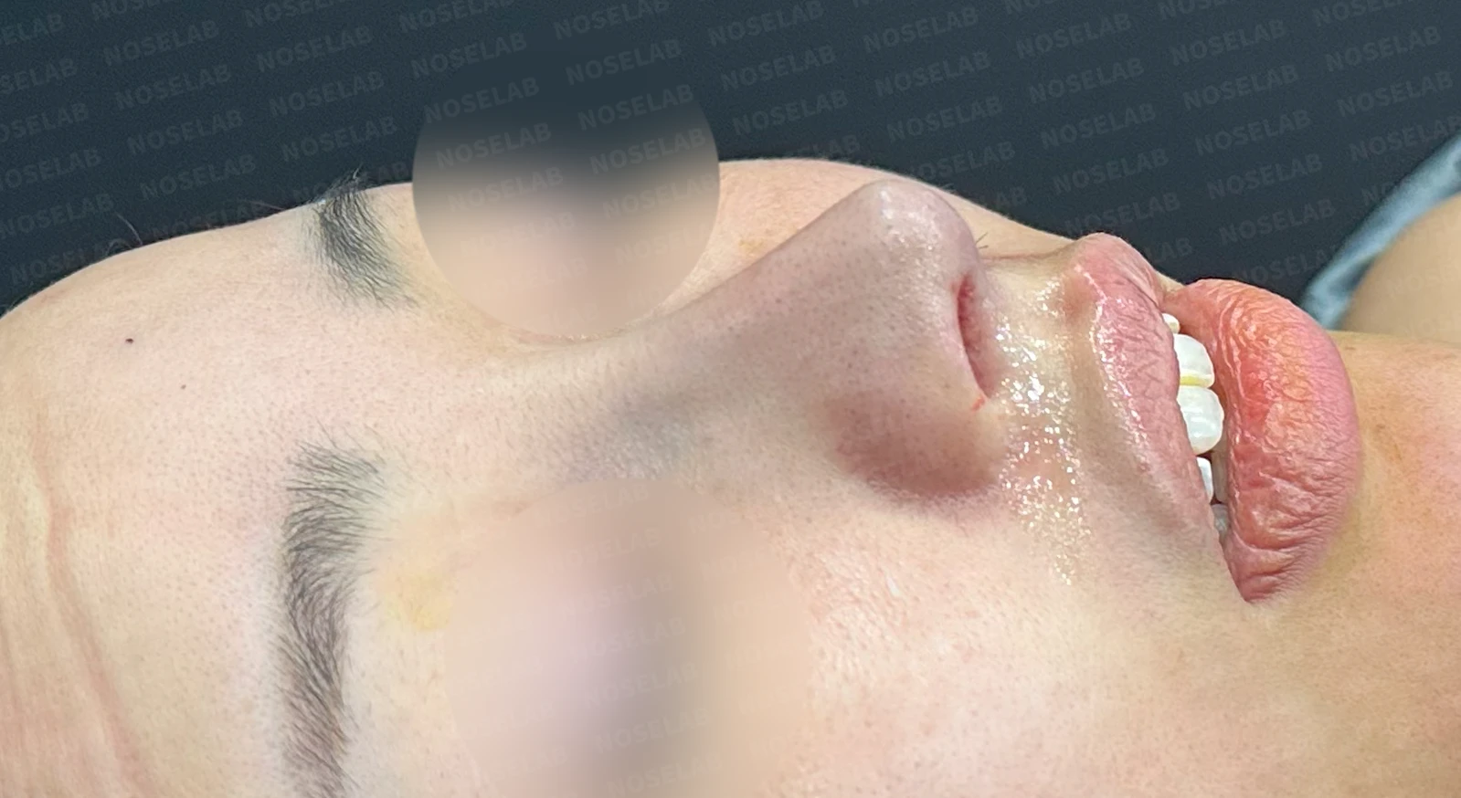 비공협착과 휜코, 코막힘을 함께 살펴보는 재수술 방법 — 수술 전 / 수술 직후 0일 직후 사진은 부기가 있는 상태로 최종 결과와 다를 수 있습니다.