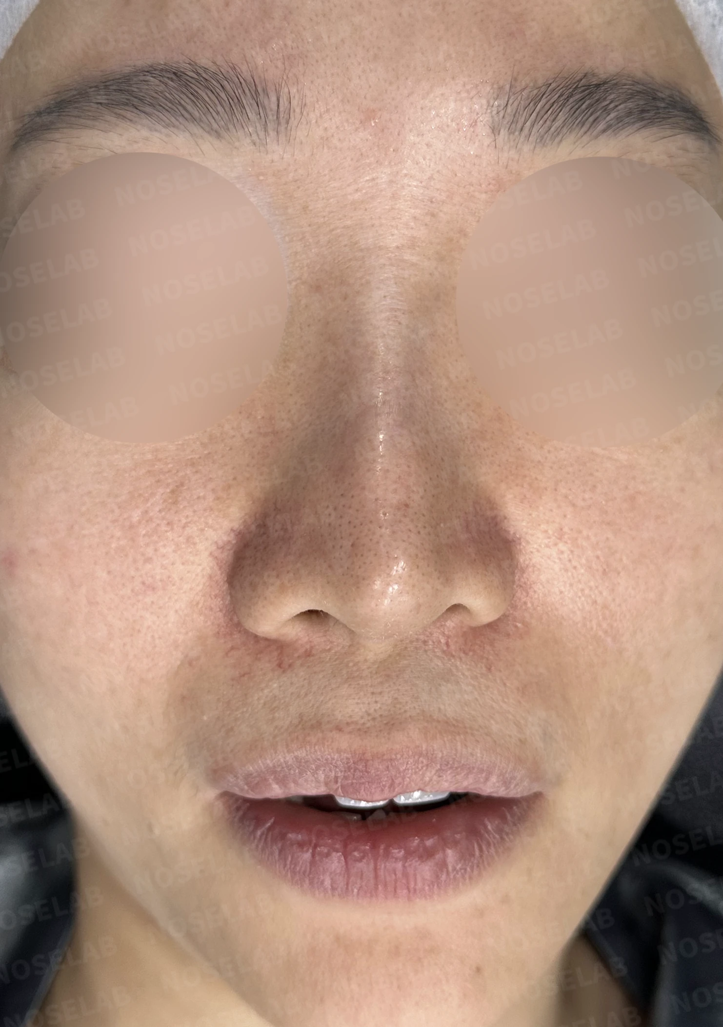 비중격이 한쪽으로 무너지면 코가 휘고 숨이 막히는 이유, 자가늑연골 재건 방법 — 수술 직후 0일 정면, 비스듬한 측면, 측면 사진입니다. 직후 사진은 부기가 있는 상태로 최종 결과와 다를 수 있습니다.