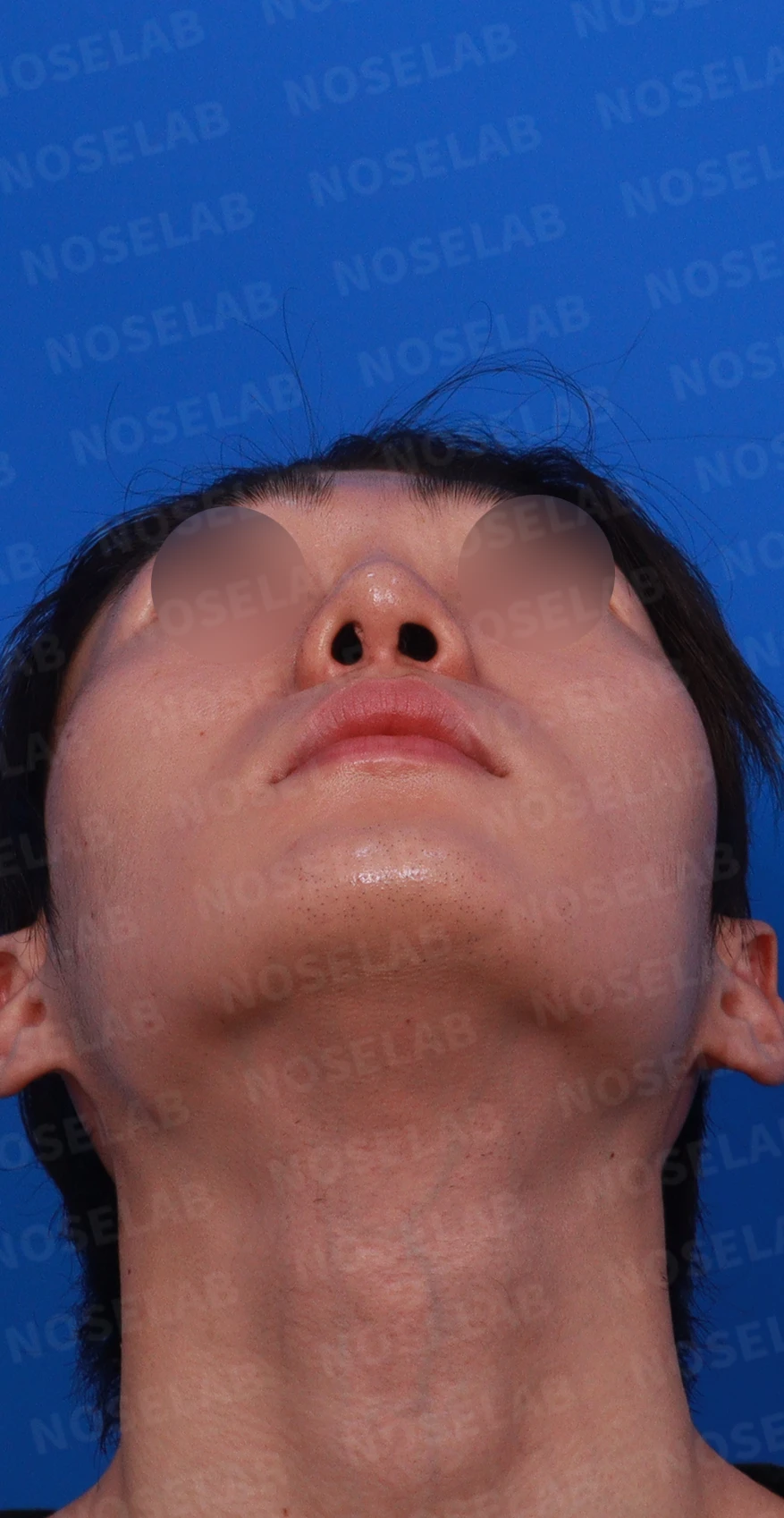 코골절과 반복 재수술 뒤 남는 흉터 조직과 비공 비대칭, 재건 방법 — 디자인 상담 우측 측면 , 비스듬한 측면 , 비공 사진입니다.