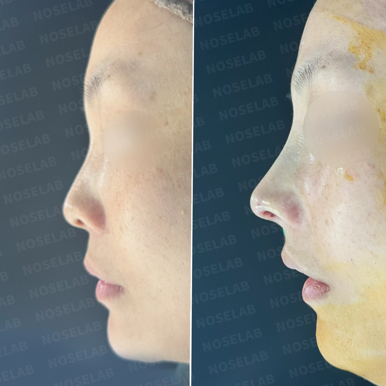 첫 코성형에서 코끝 구조와 콧구멍 노출은 어떻게 다루나 — 본문 사진 20