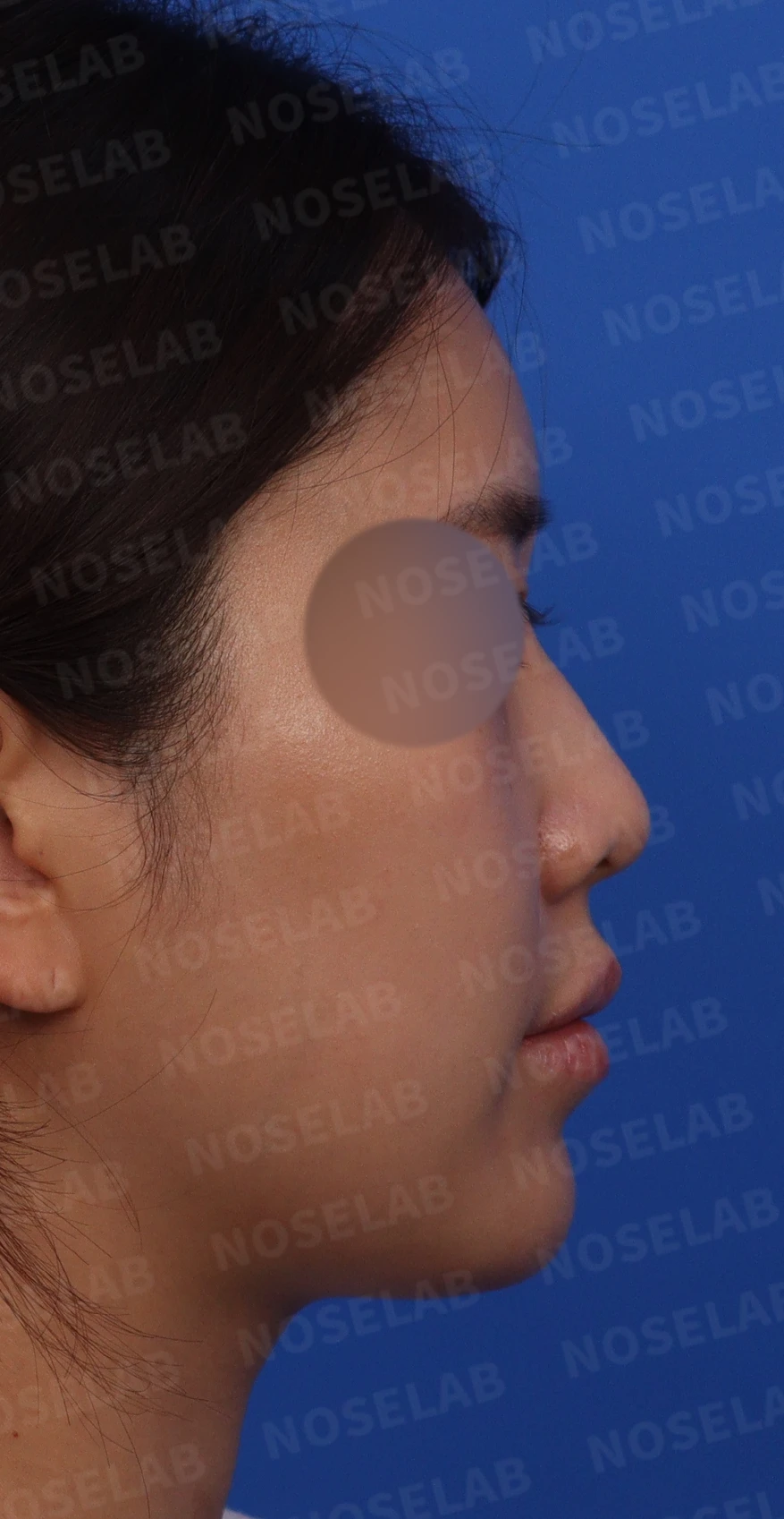 돌출입과 비순각을 함께 살펴보는 코성형 계획 — 수술전 디자인 상담 우측 측면, 비스듬한 측면, 콧구멍 사진입니다.