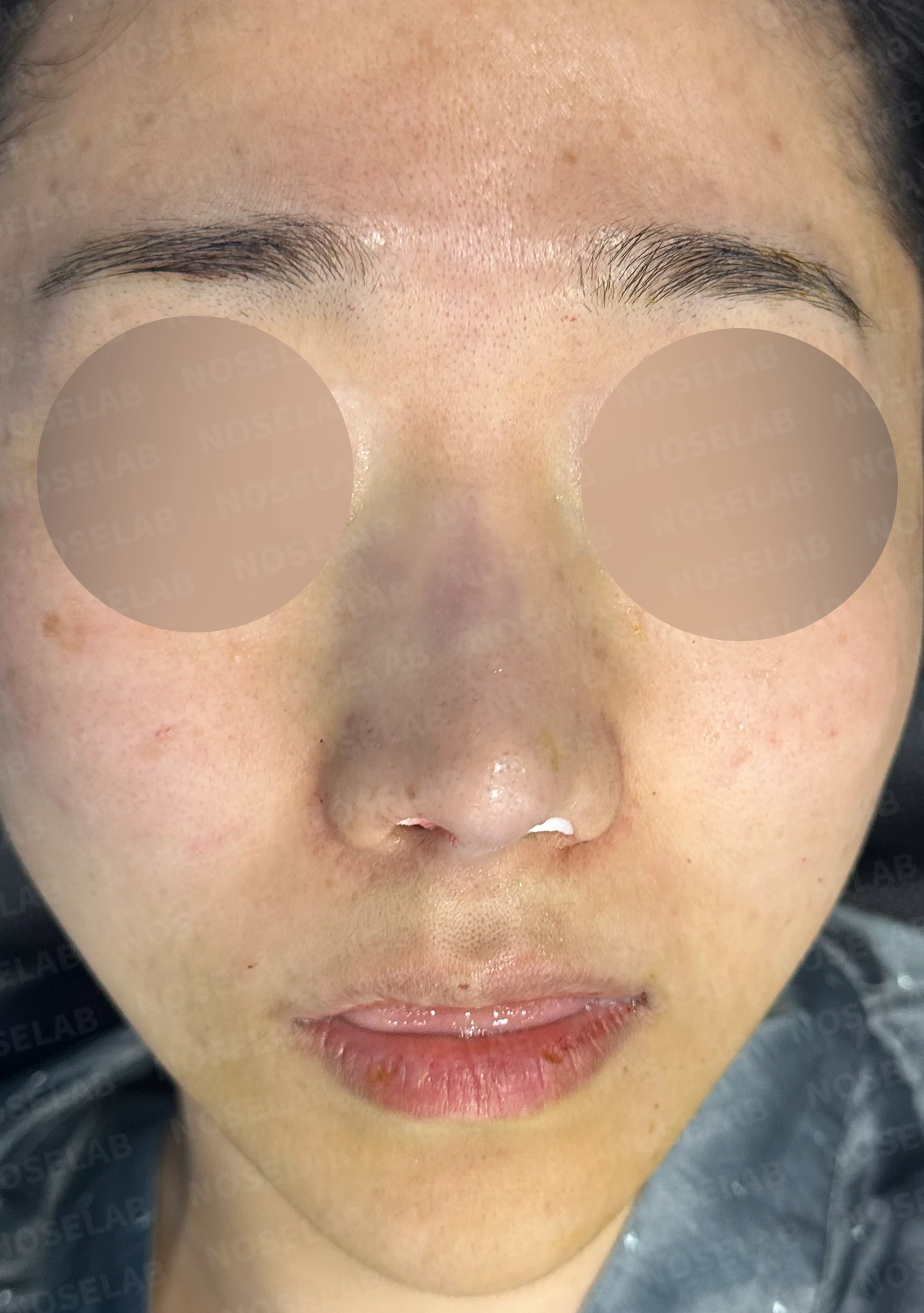 비중격 연골이 약해진 코, 보형물 없이 재건하는 방법 — 수술 직후 0일 정면, 측면, 비스듬한 측면 사진 직후 사진은 부기가 있는 상태로 최종 결과와 다를 수 있습니다.