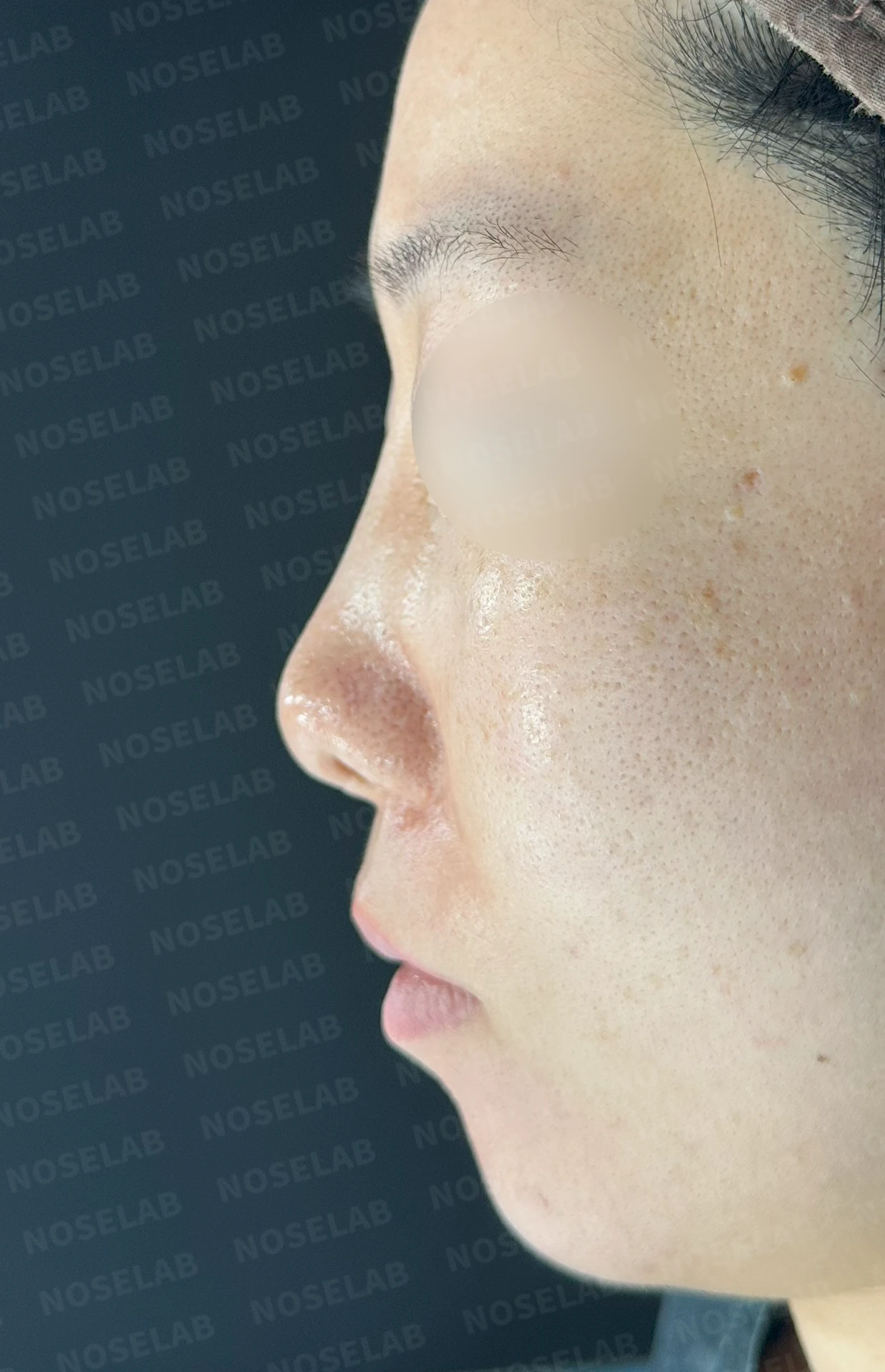 콧대 시작점이 높고 코가 휘어 보이는 이유, 자가 늑연골 교정은 어떻게 하나 — 수술 전 / 수술 직후 0일 직후 사진은 부기가 있는 상태로 최종 결과와 다를 수 있습니다.