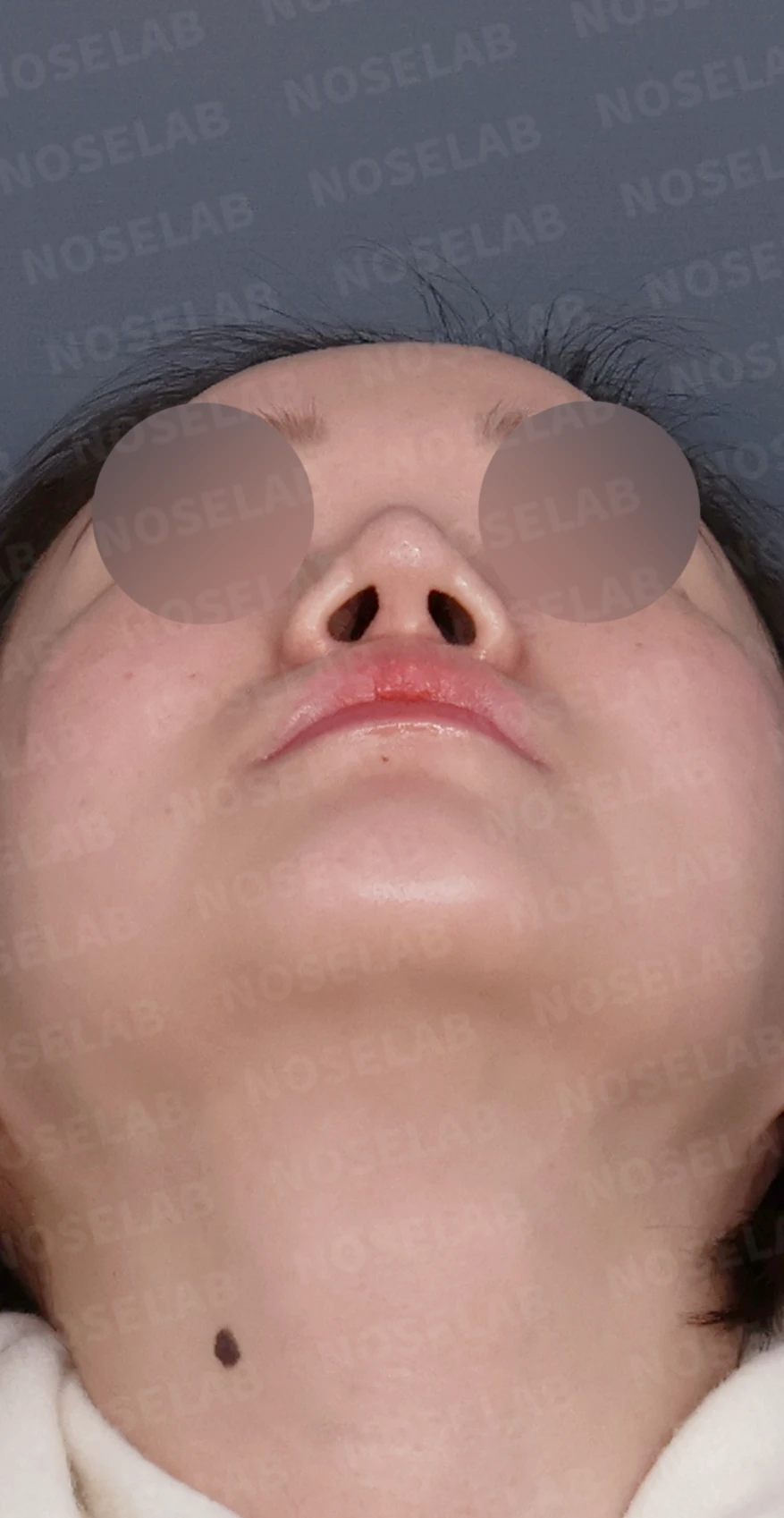비주 함몰과 콧날개 변형, 자가늑연골을 이용한 코재수술로 자연스럽게 교정 — 디자인 상담 우측 측면, 비스듬한 측면, 비공 사진입니다.