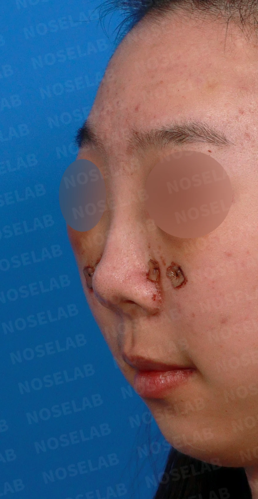 메드포어로 손상된 비중격, 자가늑연골로 완벽하게 재건하다 — 디자인 상담 정면, 좌측 측면, 비스듬한 측면 사진입니다.