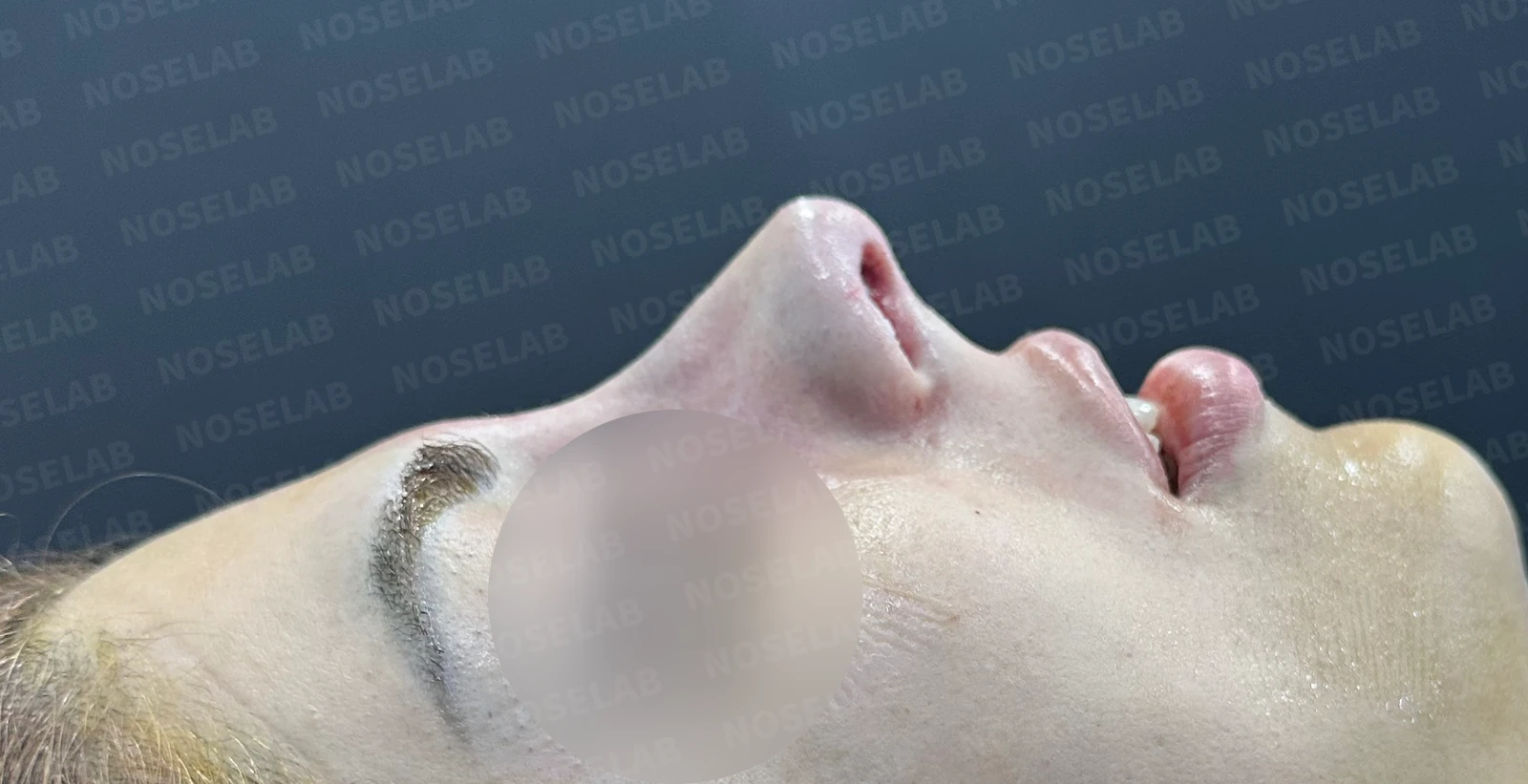 매부리코, 휜코 교정 방법 — 수술 전 / 수술 직후 0일 직후 사진은 부기가 있는 상태로 최종 결과와 다를 수 있습니다.