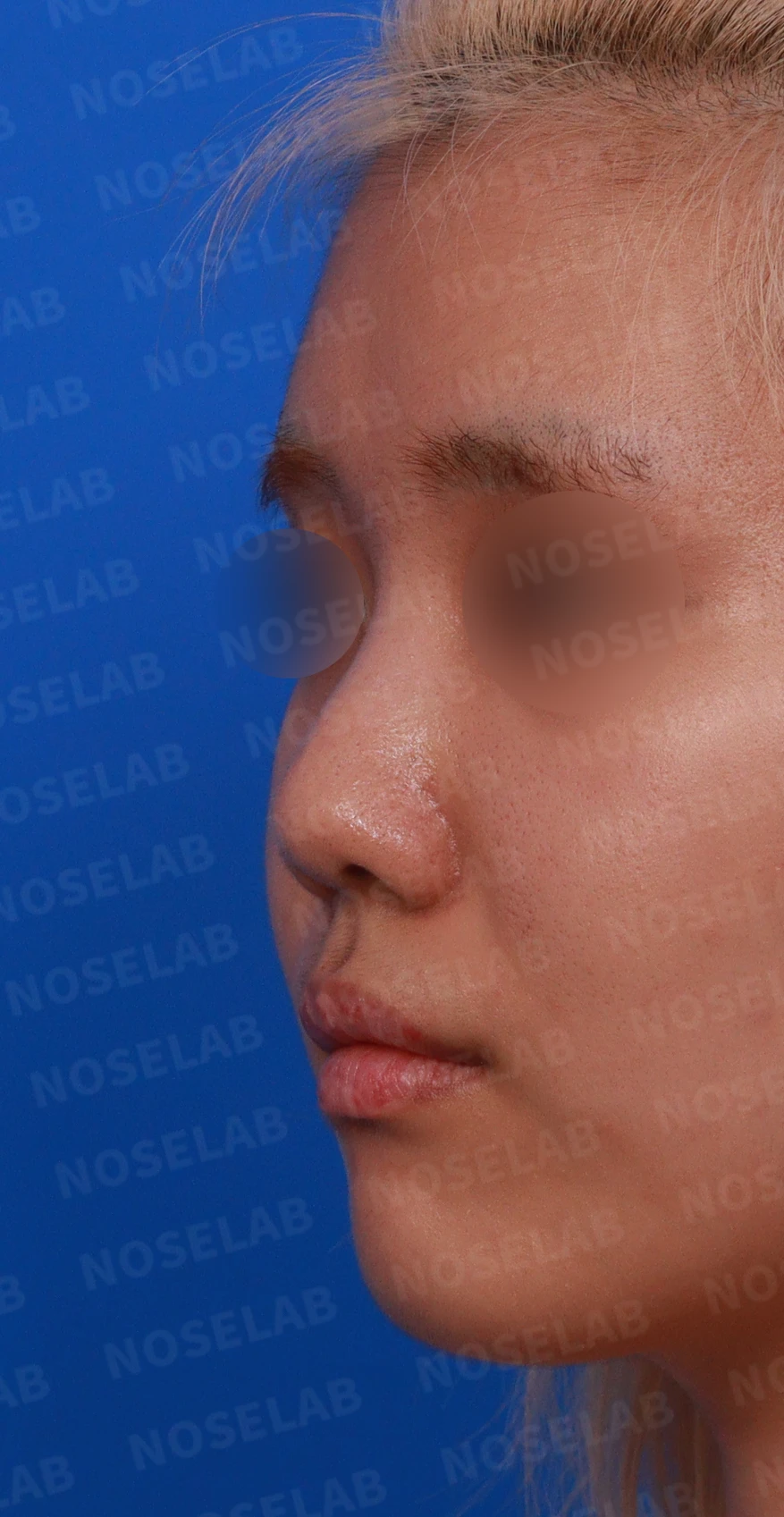 작고 뭉툭한 코는 어디까지 높일 수 있나 — 피부의 한계와 재건 방법 — 디자인 상담 정면 , 좌측 비스듬한 측면 , 측면 사진입니다.
