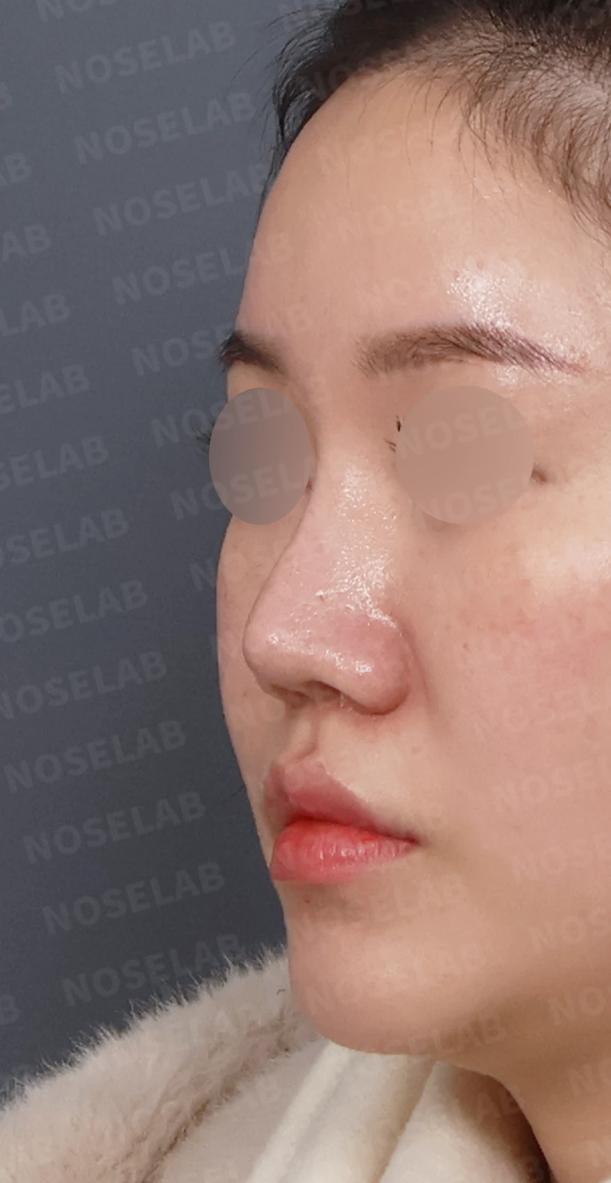 비주 함몰과 콧날개 변형, 자가늑연골을 이용한 코재수술로 자연스럽게 교정 — 디자인 상담 정면, 좌측 측면, 비스듬한 측면 사진입니다.