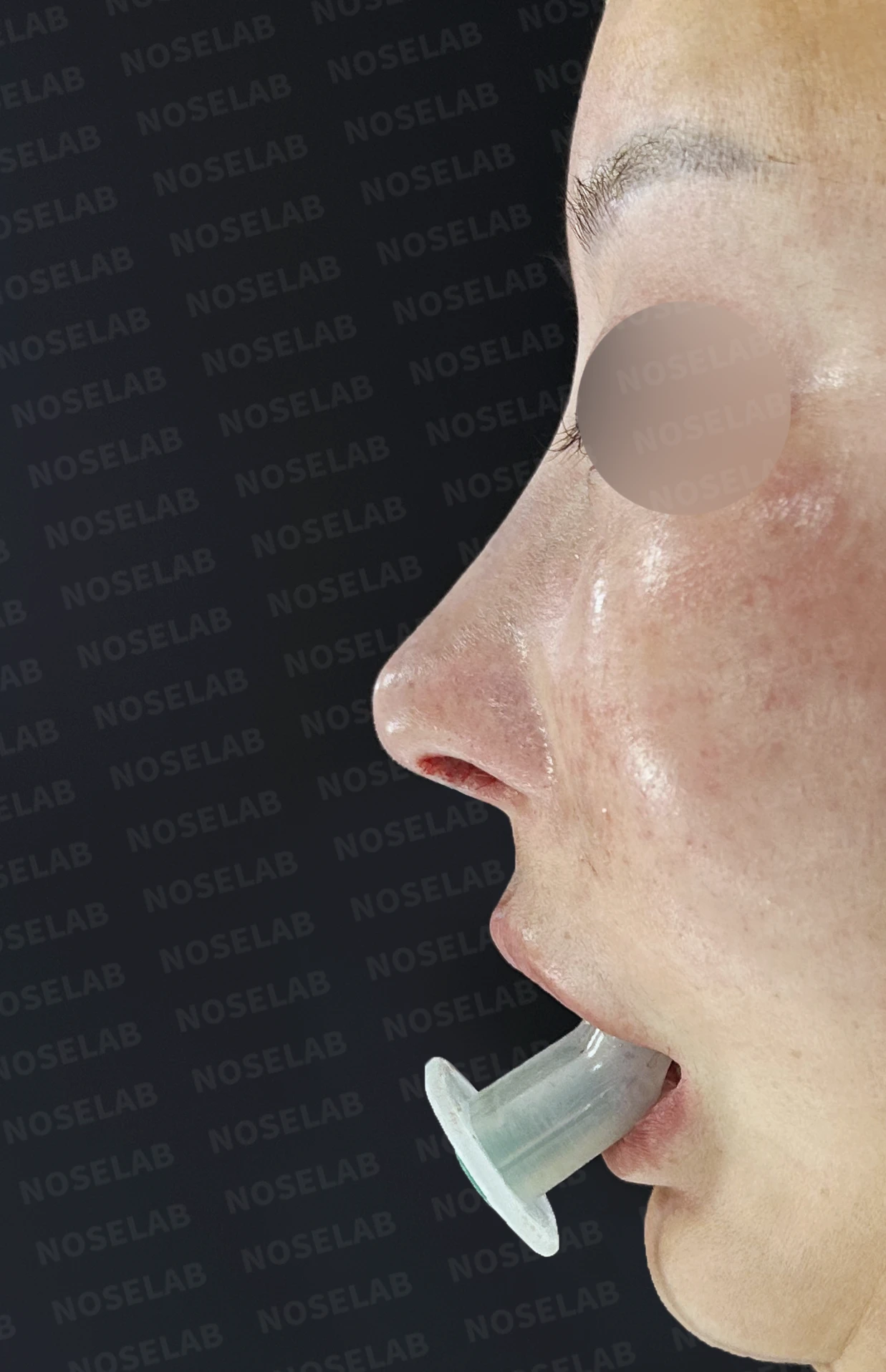코성형 뒤 코막힘이 더 심해지는 이유, 비중격 재건과 절골 복원은 어떻게 하나 — 수술 직후 0일 정면, 비스듬한 측면, 측면 사진입니다. 직후 사진은 부기가 있는 상태로 최종 결과와 다를 수 있습니다.