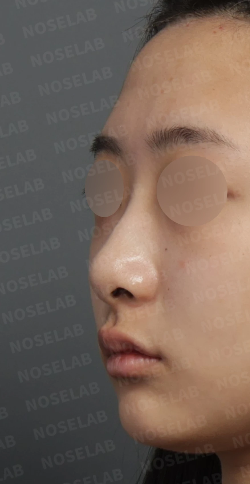 들린 코와 처진 비주, 비중격연장술로 자연스러운 직반라인 완성한 코성형 — 디자인 상담 정면, 좌측 비스듬한 측면, 측면 사진입니다.