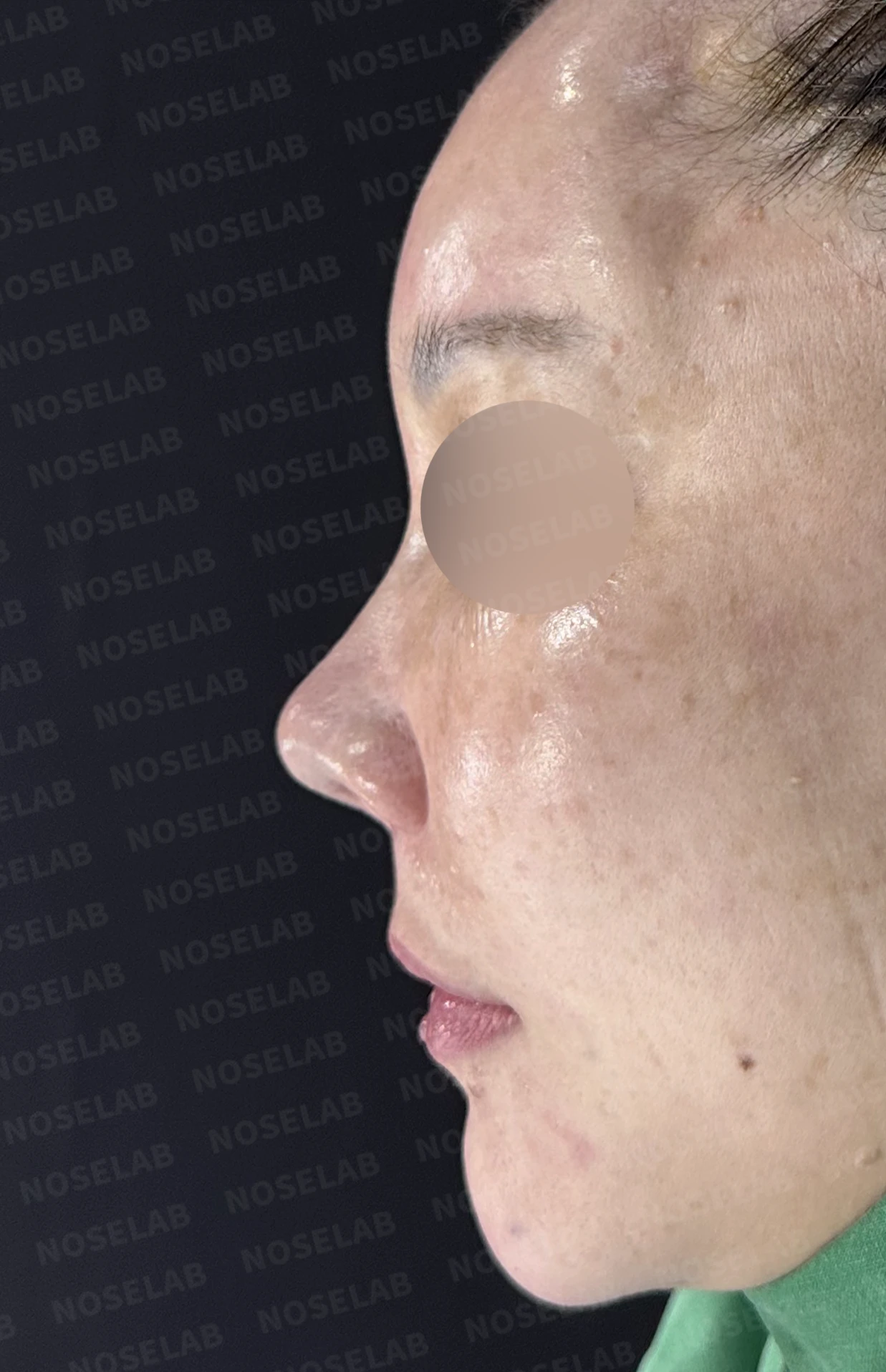 뭉툭하고 길게 처진 코가 중안면부를 길어 보이게 하는 이유, 석회화된 늑연골 재건 방법 — 수술 직후 0일 정면, 비스듬한 측면, 측면 사진입니다. 직후 사진은 부기가 있는 상태로 최종 결과와 다를 수 있습니다.