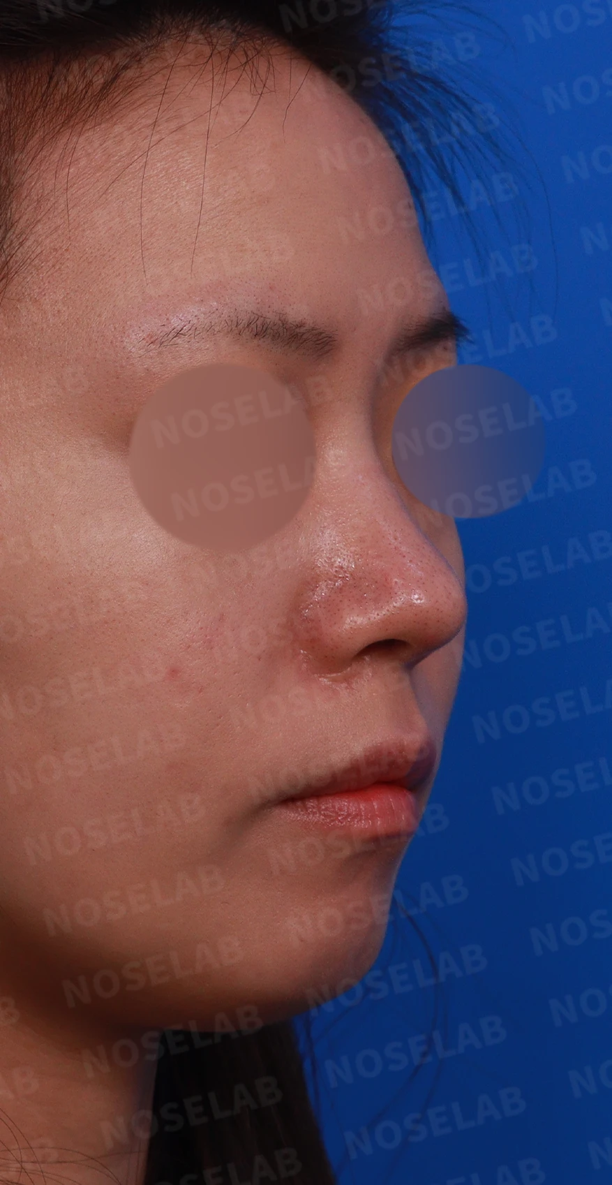 재수술 뒤에도 복코와 퍼진 코끝이 남는 이유, 자가 늑연골 재건은 어떻게 하나 — 디자인 상담 우측 비스듬한 측면, 측면, 비공 사진입니다.
