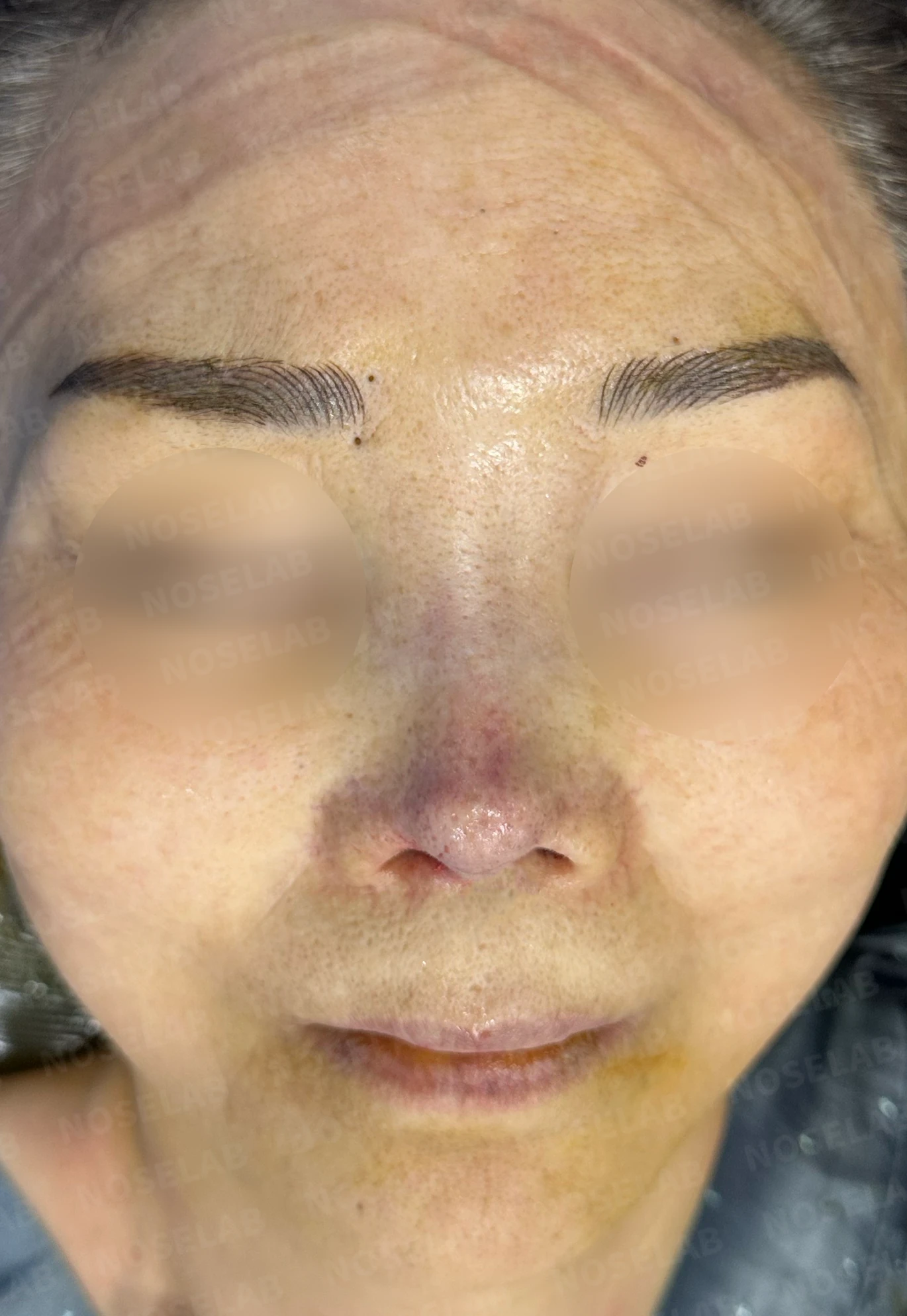 비중격 천공이 있는 코의 재수술 계획 — 수술 전 / 수술 직후 0일 직후 사진은 부기가 있는 상태로 최종 결과와 다를 수 있습니다.