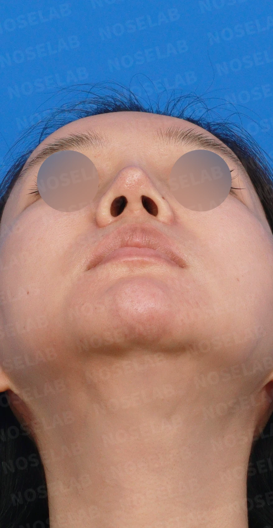 영구 필러가 코 모양을 바꾸는 과정과 제거 후 재건 방법 — 디자인 상담 우측 측면, 비스듬한 측면, 비공 사진입니다.