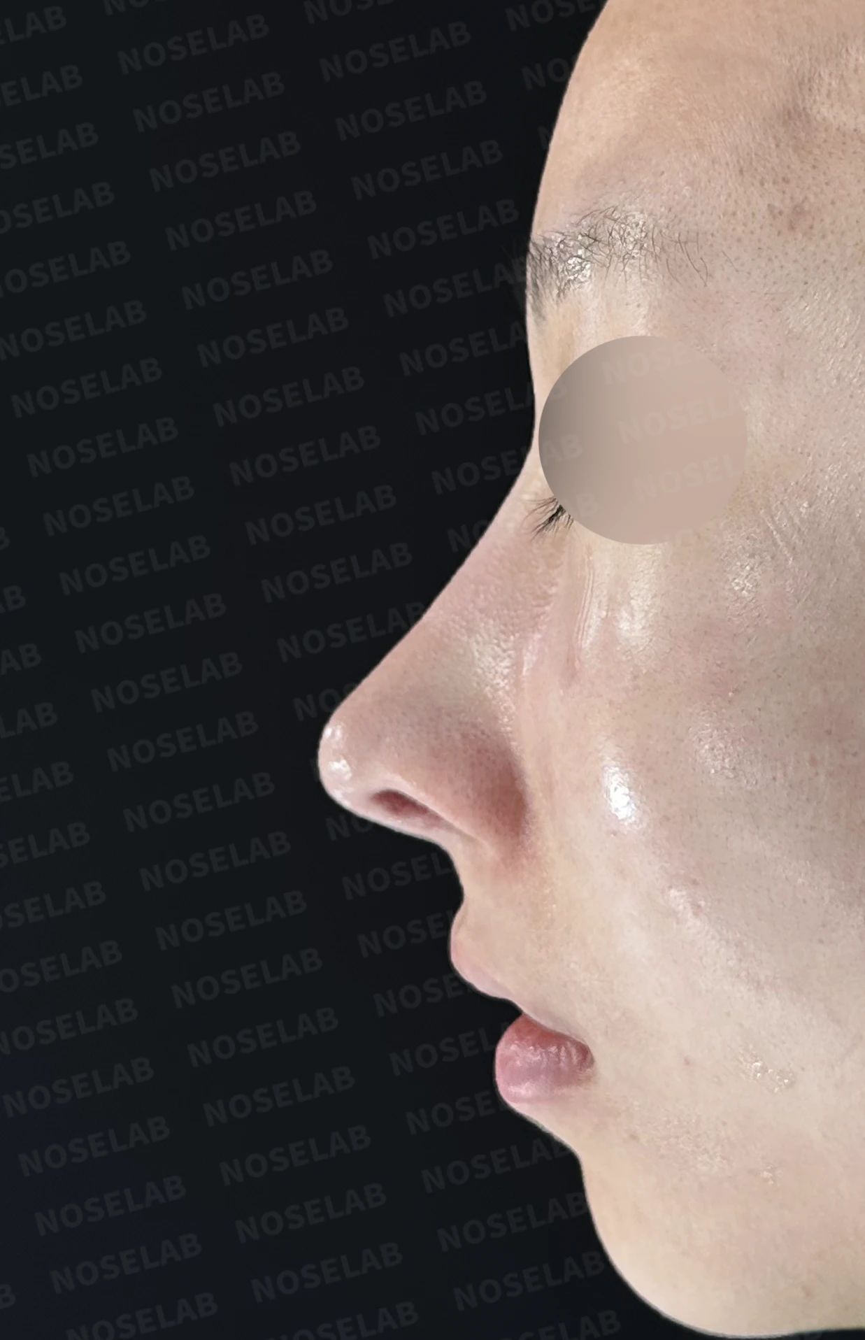길고 처진 코, 휜코 교정과 코막힘까지 한 번에 해결한 재수술 사례 — 직후 정면, 비스듬한 측면, 측면 사진입니다.