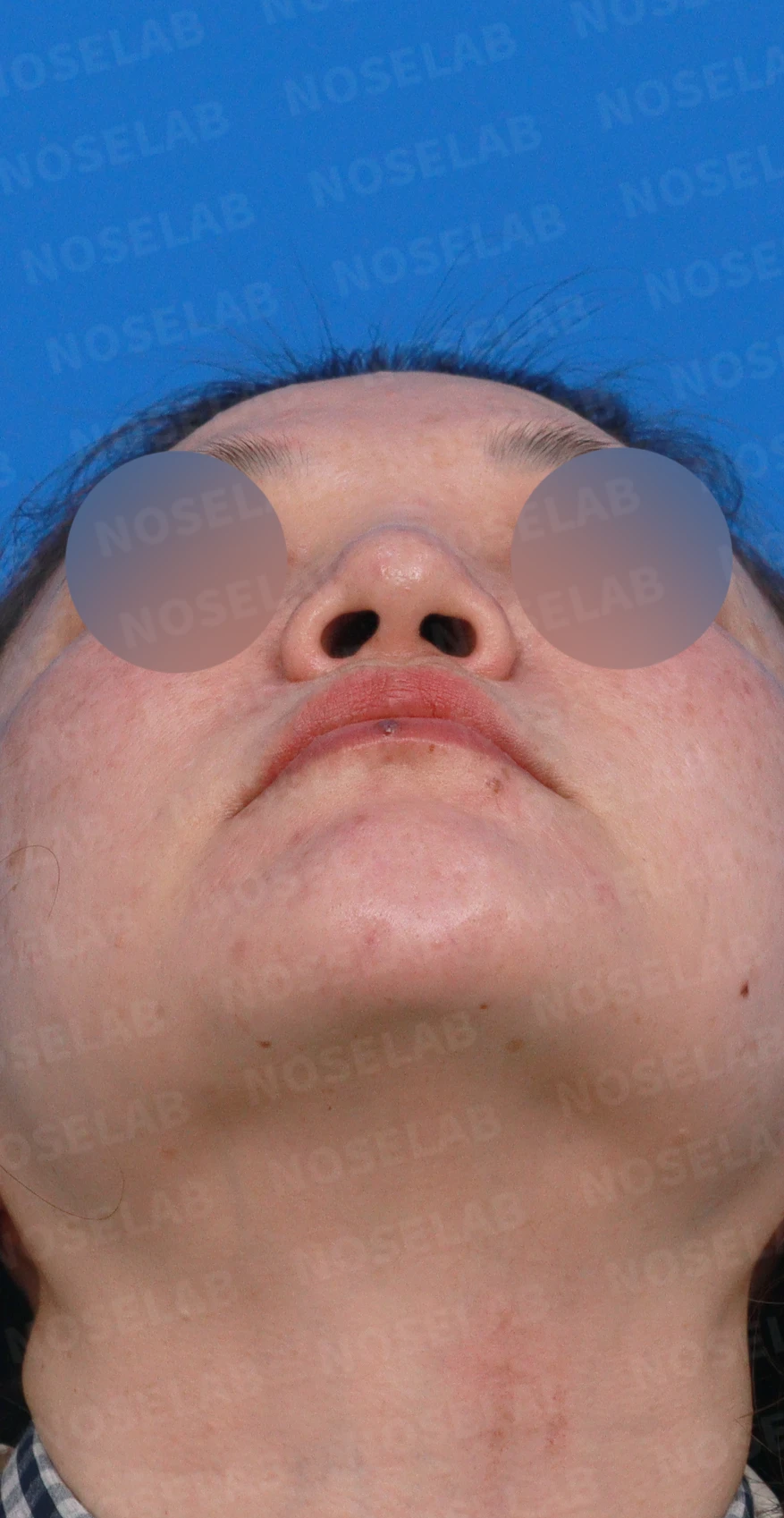뭉툭하고 길게 처진 코가 중안면부를 길어 보이게 하는 이유, 석회화된 늑연골 재건 방법 — 디자인 상담 우측 측면, 비스듬한 측면, 비공 사진입니다.