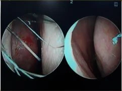 비중격이 한쪽으로 무너지면 코가 휘고 숨이 막히는 이유, 자가늑연골 재건 방법 — 수술 전 / 수술 후 (촬영 시점 미기재)