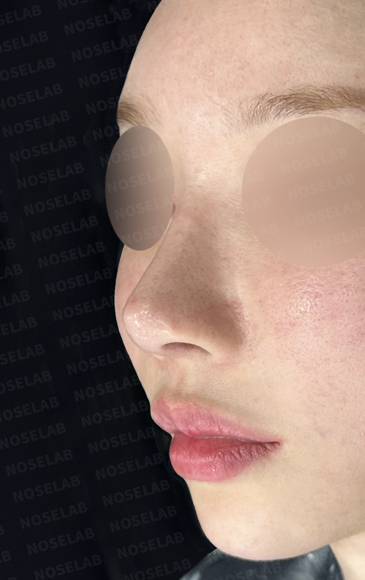 여러 차례 코수술 후 자가늑연골과 자가진피로 코 전체를 자연스럽게 높인 재수술 — 전(좌) 직후(후)