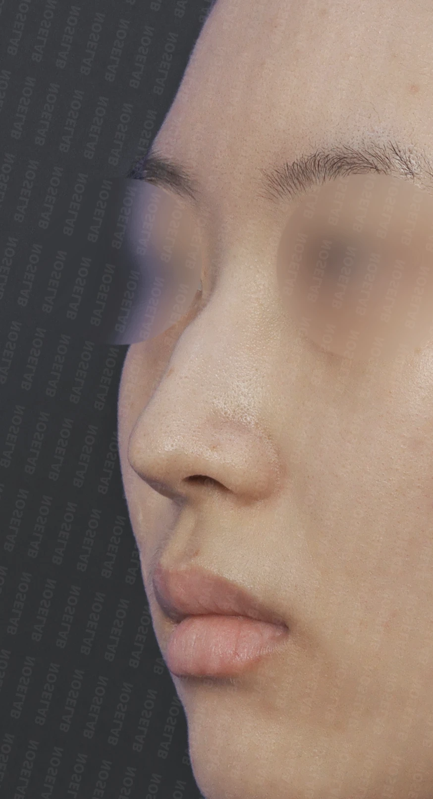 매부리코에 코의 휨과 비공 비대칭이 함께 오는 이유, 비중격 연골 교정은 어떻게 하나 — 수술 전 / 수술 직후 0일 직후 사진은 부기가 있는 상태로 최종 결과와 다를 수 있습니다.