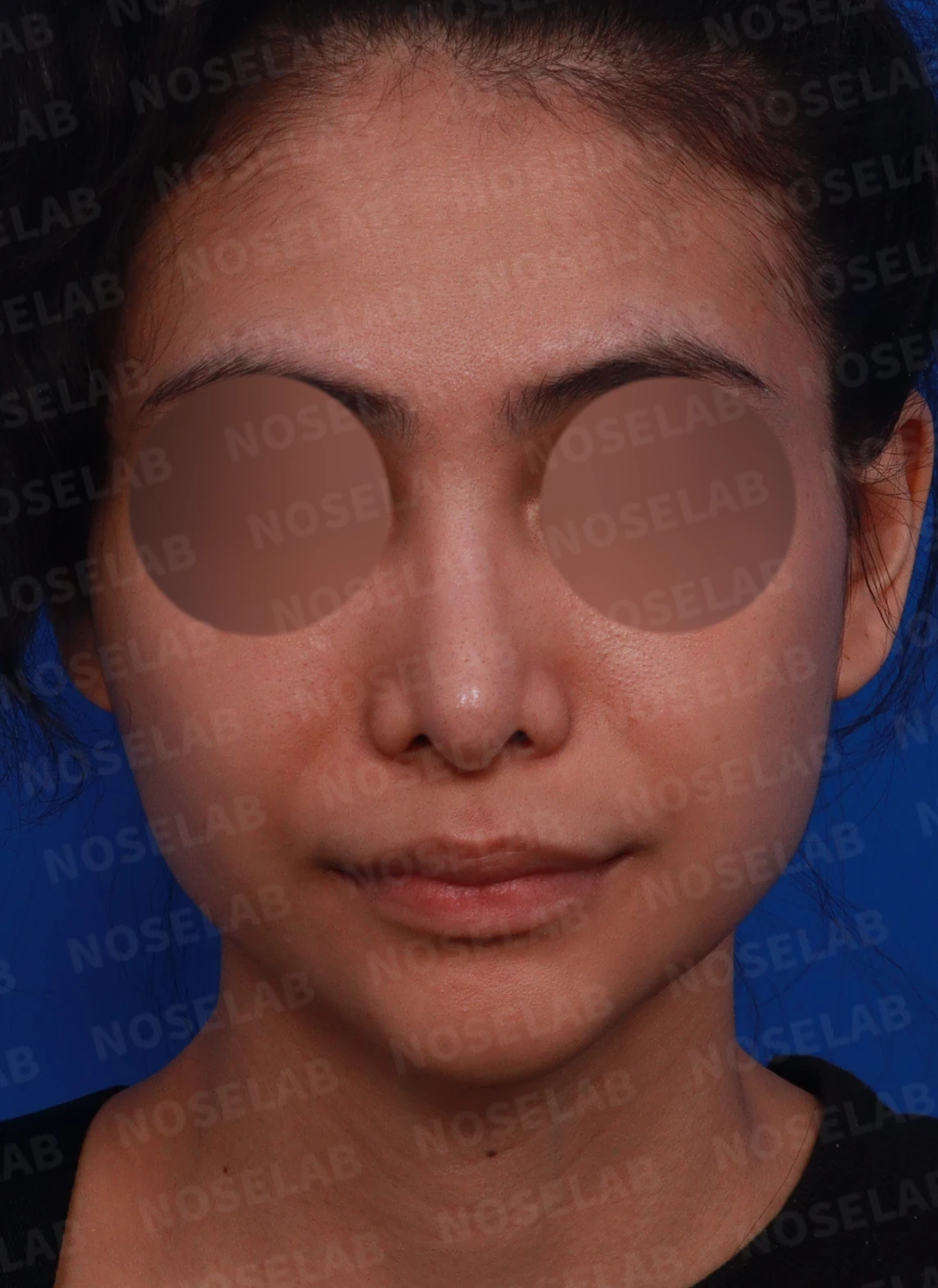 비주가 심하게 처지고 화살코가 되는 이유와 늑연골 재건 방법 — 디자인 상담 정면, 좌측 측면, 비스듬한 측면 사진