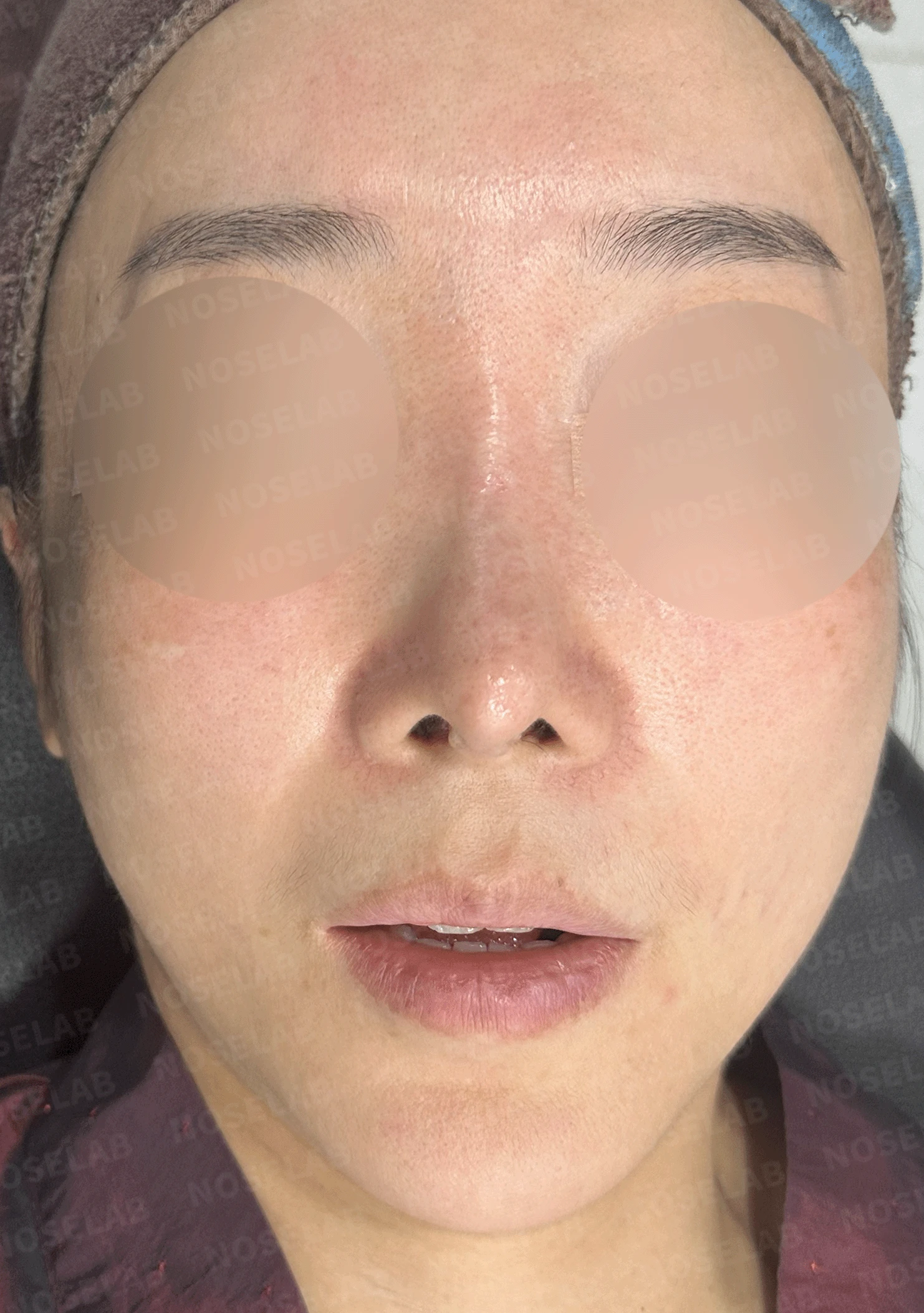반복된 코재수술 뒤 안장코와 비밸브 협착이 생기는 이유, 전체 재건은 어떻게 하나 — 본문 사진 7