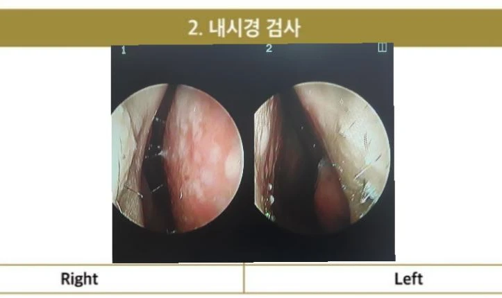 안면 비대칭이 있는 코에 맞춤형 보형물을 쓰는 이유와 매부리 교정 방법 — 내시경 사진