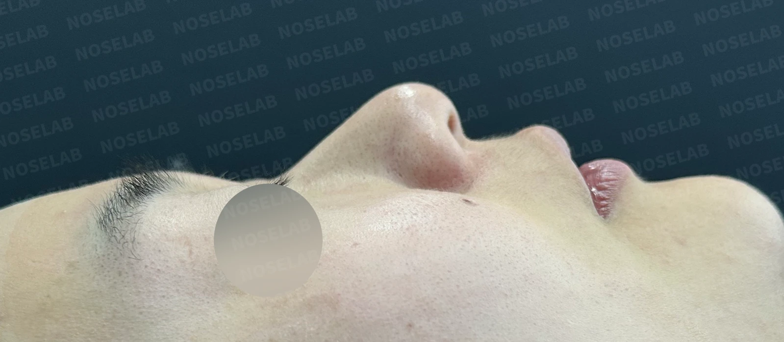 복코 수술은 어떻게 하나요? — 수술 전 / 수술 직후 0일 직후 사진은 부기가 있는 상태로 최종 결과와 다를 수 있습니다.