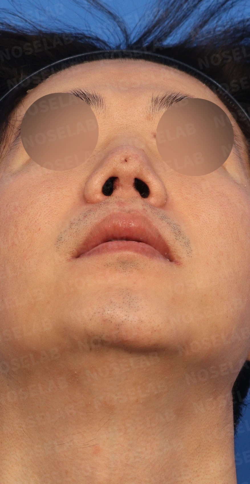 구축코, 들린코, 남자코 교정 사례 — 디자인 상담 우측 측면, 비스듬한 측면, 비공 사진입니다.