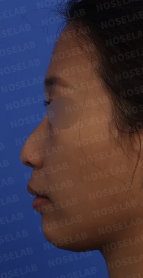 갈라져 보이는 코끝의 구조와 교정 방법 — 본문 사진 2