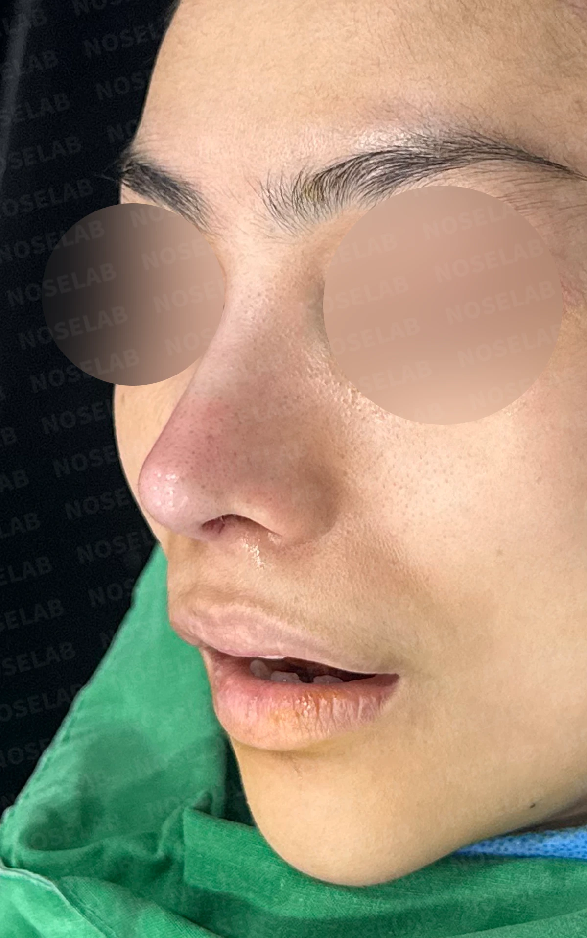 비주가 심하게 처지고 화살코가 되는 이유와 늑연골 재건 방법 — 수술 전 / 수술 직후 0일 직후 사진은 부기가 있는 상태로 최종 결과와 다를 수 있습니다.