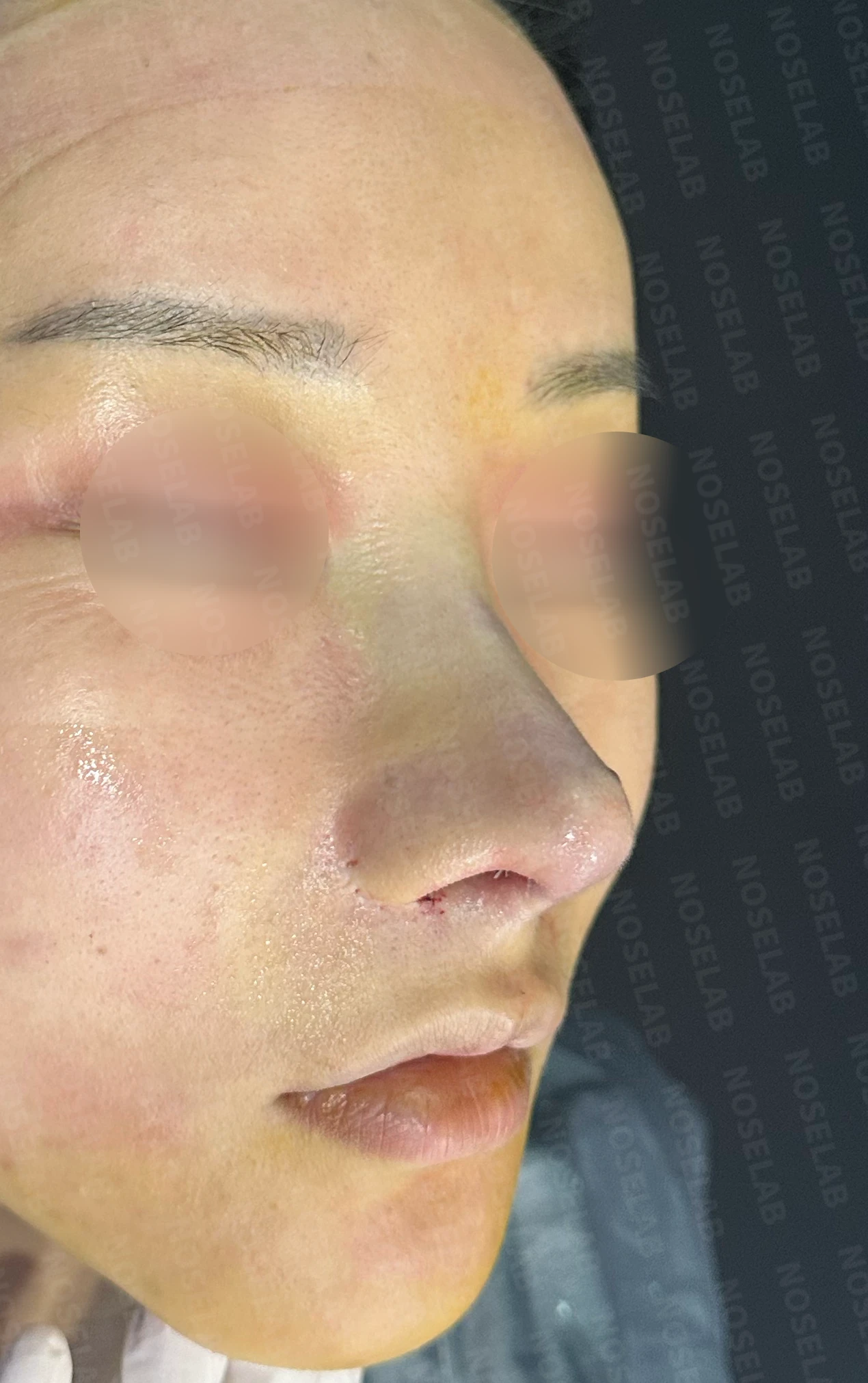 비공 비대칭, 퍼진코! 코재수술 사례 — 직후 정면, 측면, 비스듬한 측면