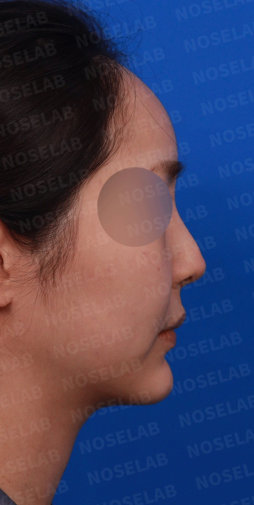 코끝 처짐과 코막힘을 함께 살펴보는 재수술 방법 — 디자인 상담 우측 측면, 비스듬한 측면, 비공 사진입니다.