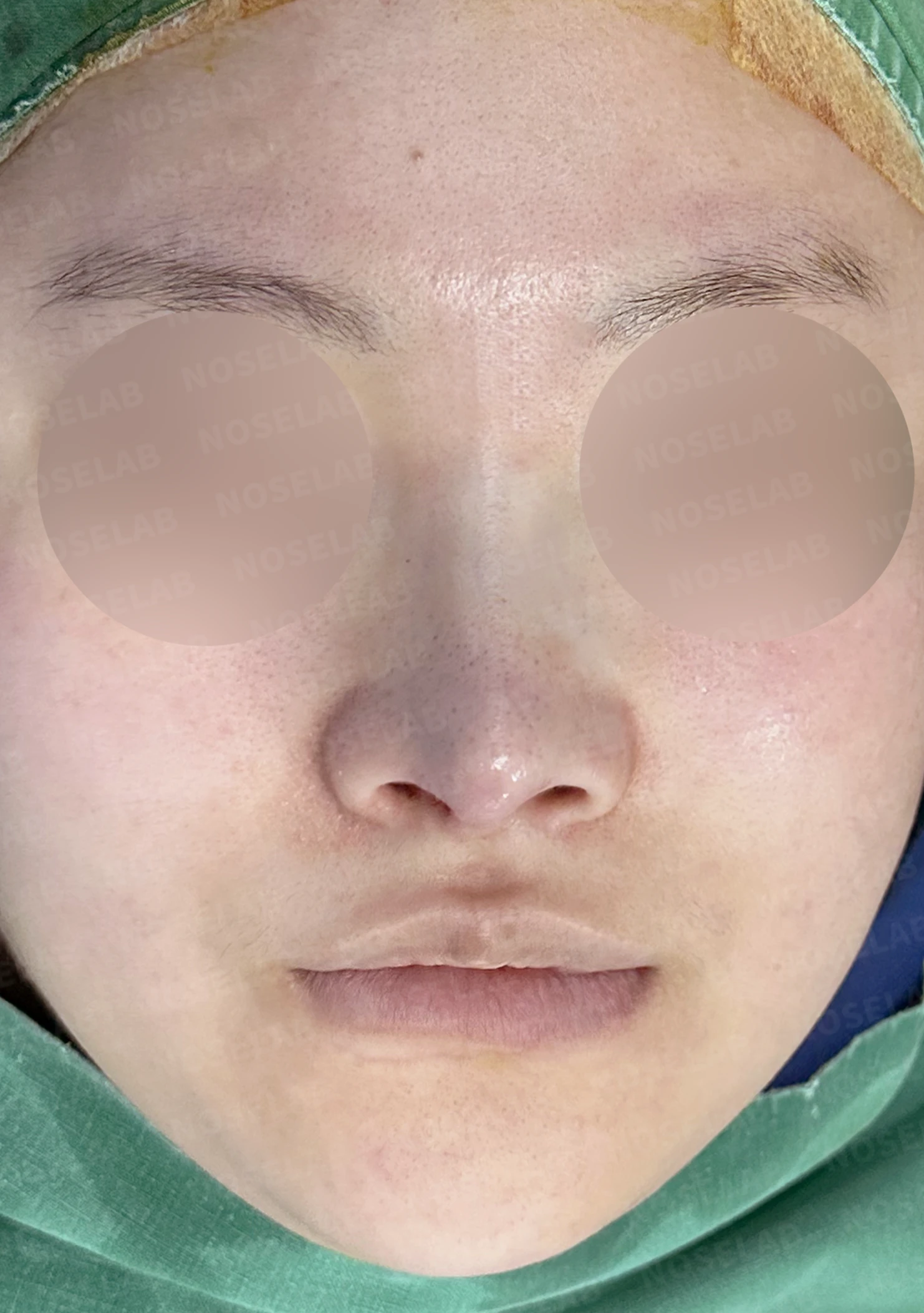 코가 퍼지고 코끝이 뭉툭해 보이는 이유, 비중격연골과 귀연골 교정은 어떻게 하나 — 수술 직후 0일 정면, 비스듬한 측면, 측면 사진입니다. 직후 사진은 부기가 있는 상태로 최종 결과와 다를 수 있습니다.