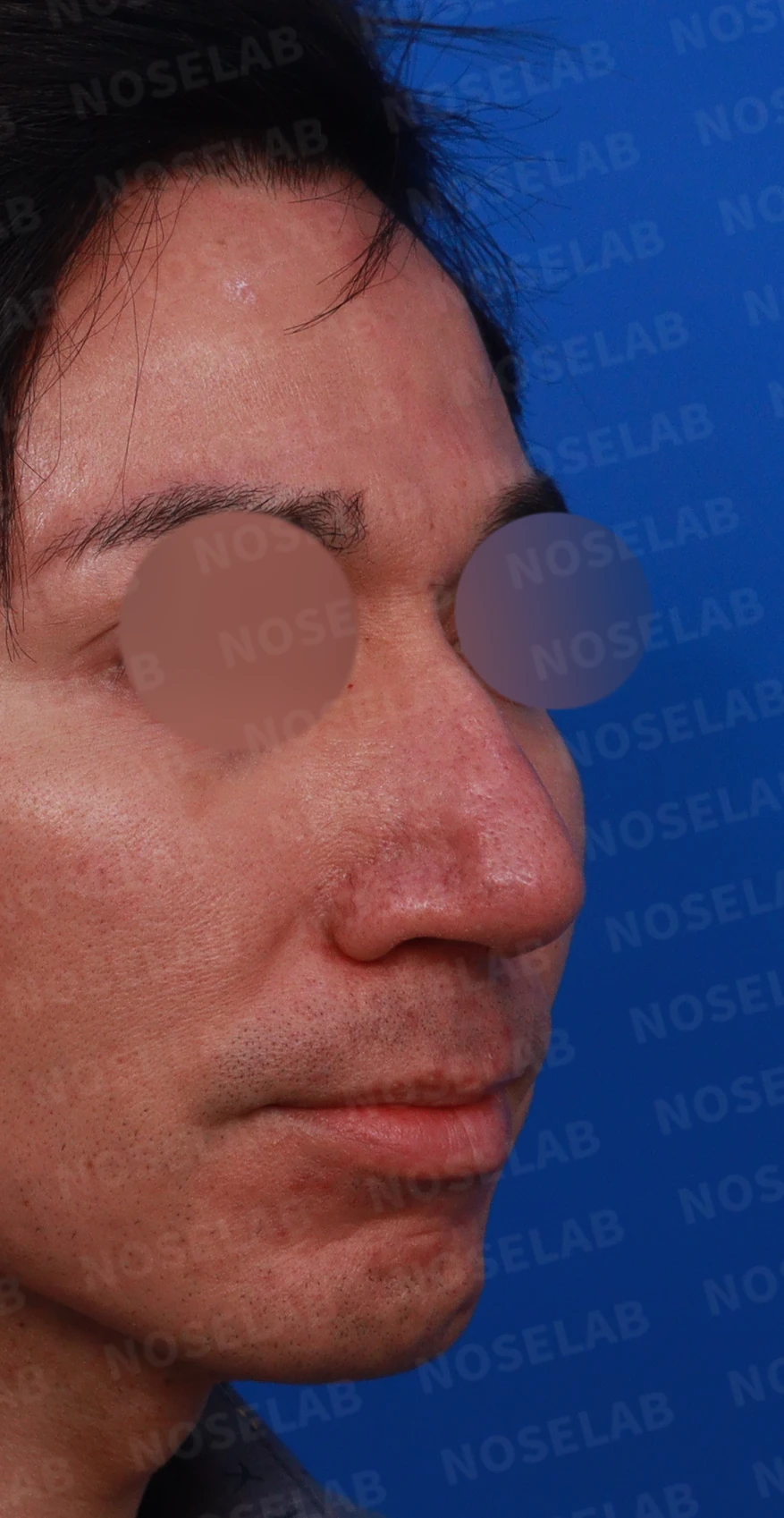 큰 코와 얼굴 비율을 함께 고려한 교정 방법 — 디자인 상담 우측 측면, 비스듬한 측면, 비공 사진입니다.