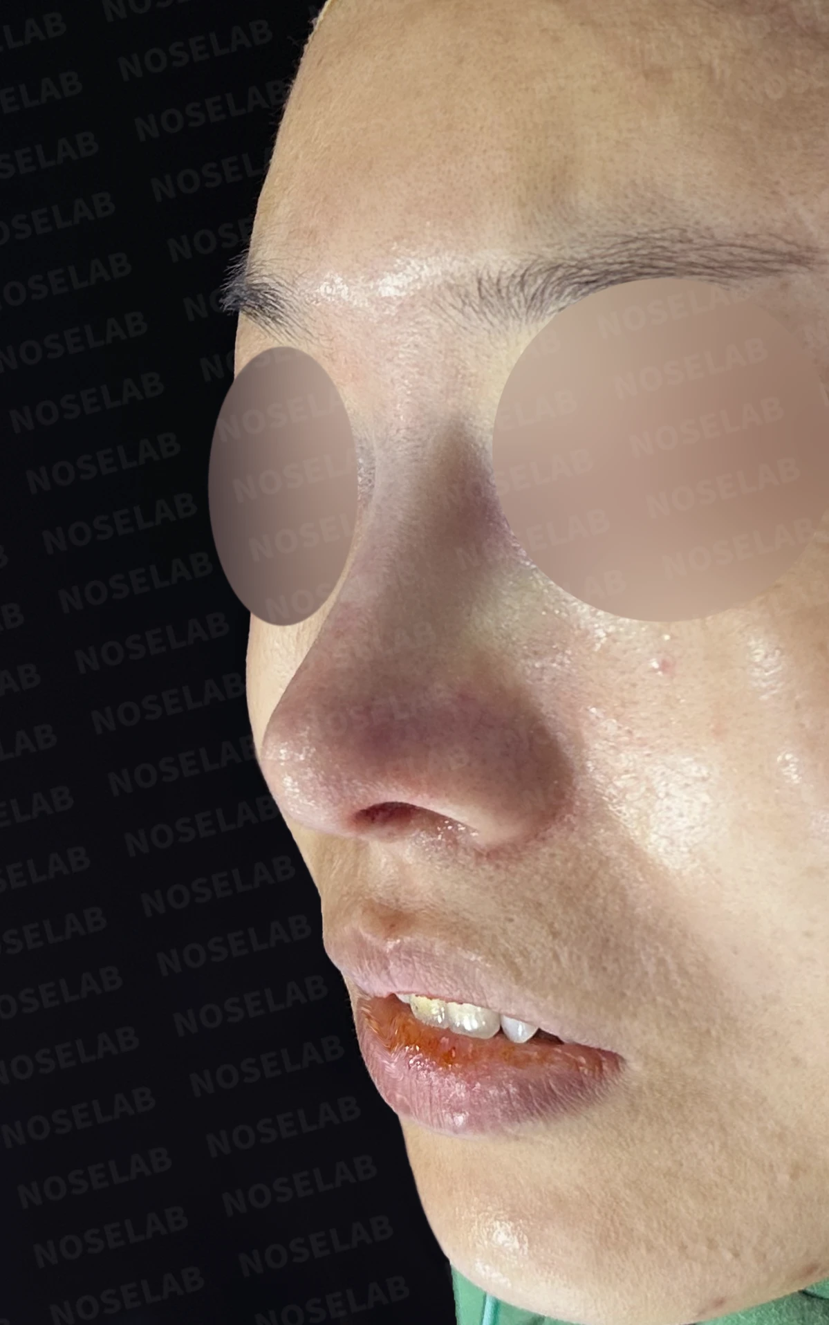 비공 비대칭과 휘어진 코, 자가늑연골 재건으로 교정한 코재수술 — 직후 정면, 비스듬한 측면, 측면 사진