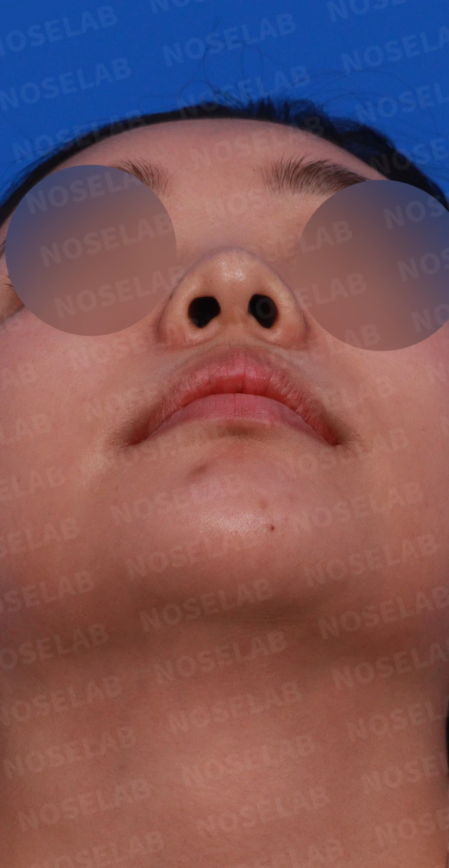 비염 수술을 받았는데도 코막힘이 돌아오는 이유, 구조 교정은 어떻게 하나 — 디자인 상담 우측 측면, 비스듬한 측면, 비공 사진