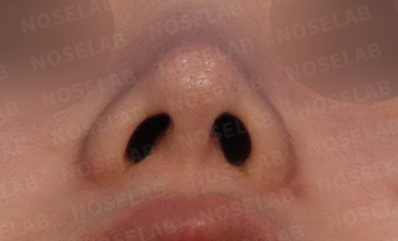 퍼진 코 개선과 콧구멍 비대칭 교정 방법 — 본문 사진 4