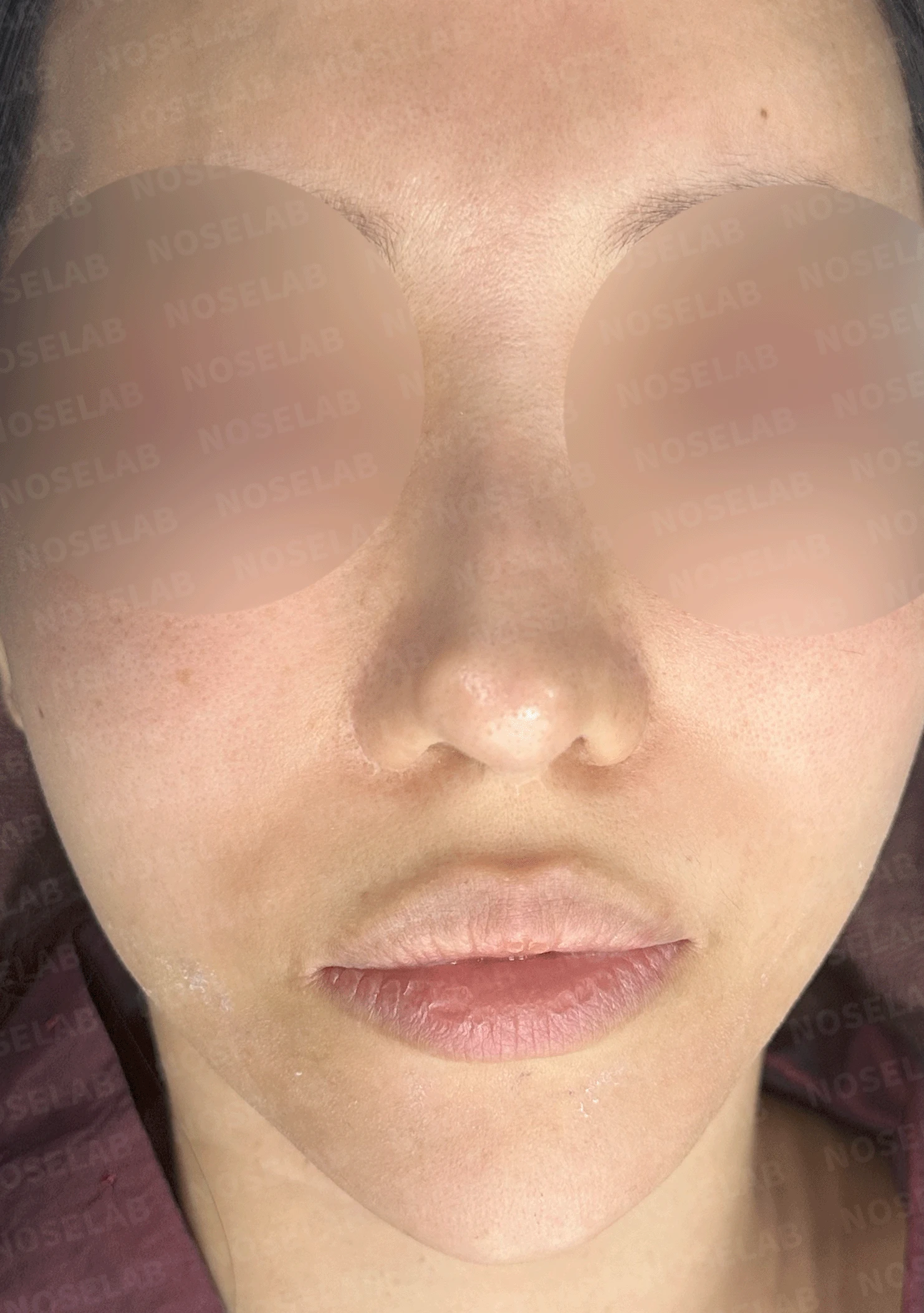 14년간 7차례 수술 후 비중격천공과 복잡한 코끝 문제 해결 - 자가늑연골 재건 실제 후기 — 본문 사진 11