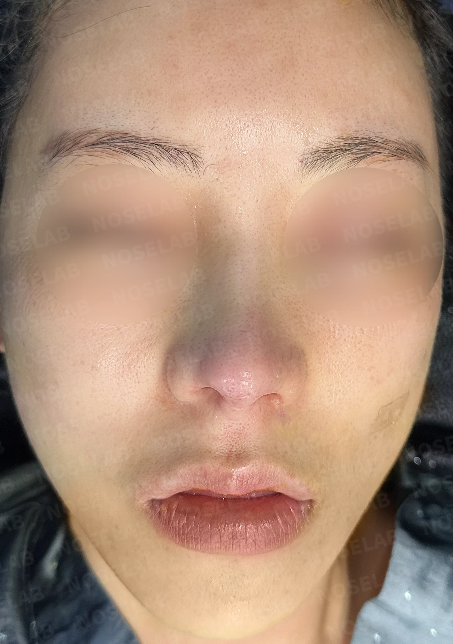 높은 콧대 시작점을 낮추는 방법 — 수술 전 / 수술 직후 0일 직후 사진은 부기가 있는 상태로 최종 결과와 다를 수 있습니다.