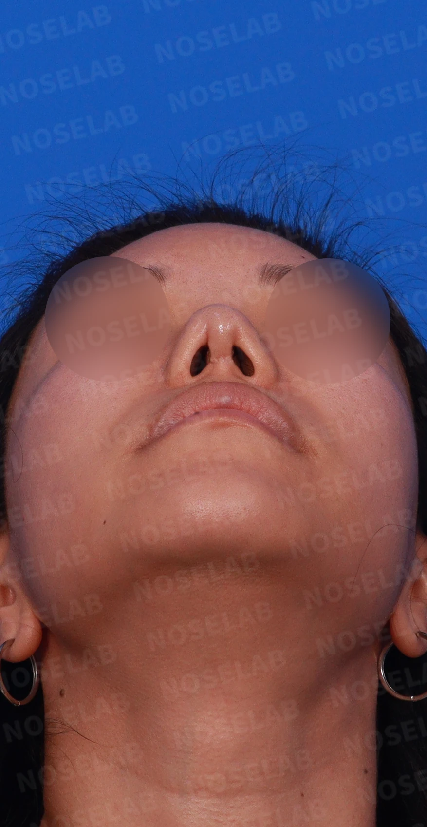 코성형 뒤 감염이 반복되는 이유, 염증 치료와 단계적 재건은 어떻게 하나 — 디자인 상담 우측 측면 , 비스듬한 측면 , 비공 사진입니다.