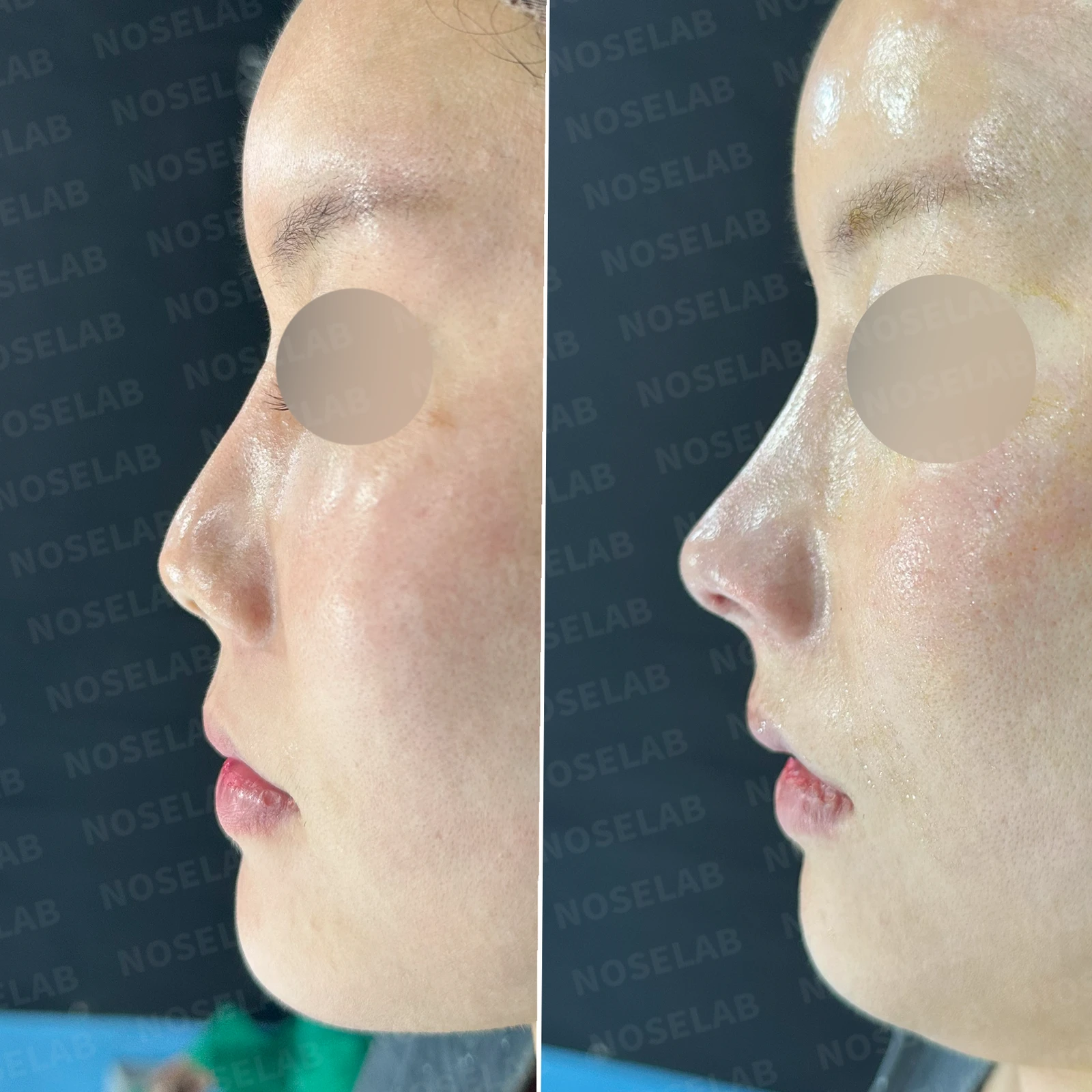 기증 늑연골이 흡수되면 코가 어떻게 변하고, 자가 늑연골 재건은 어떻게 하나 — 본문 사진 20