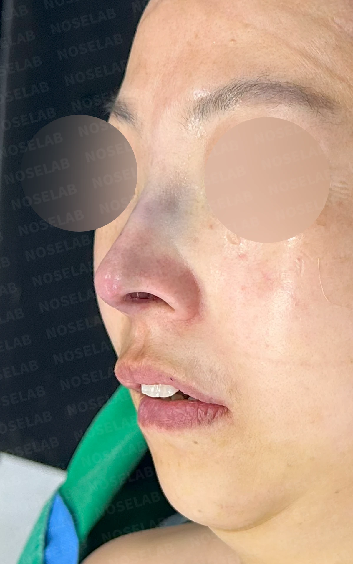 들창코에서 콧구멍이 많이 보이는 이유, 코끝 위치 교정은 어떻게 하나 — 수술 전 / 수술 직후 0일 직후 사진은 부기가 있는 상태로 최종 결과와 다를 수 있습니다.