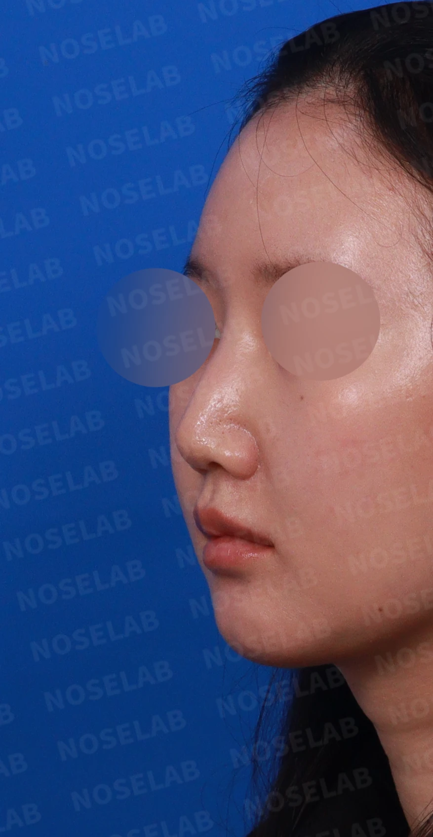 비공 비대칭과 코끝 처짐은 왜 생기나, 연골을 병용한 재건 방법 — 디자인 상담 정면, 좌측 측면, 비스듬한 측면 사진